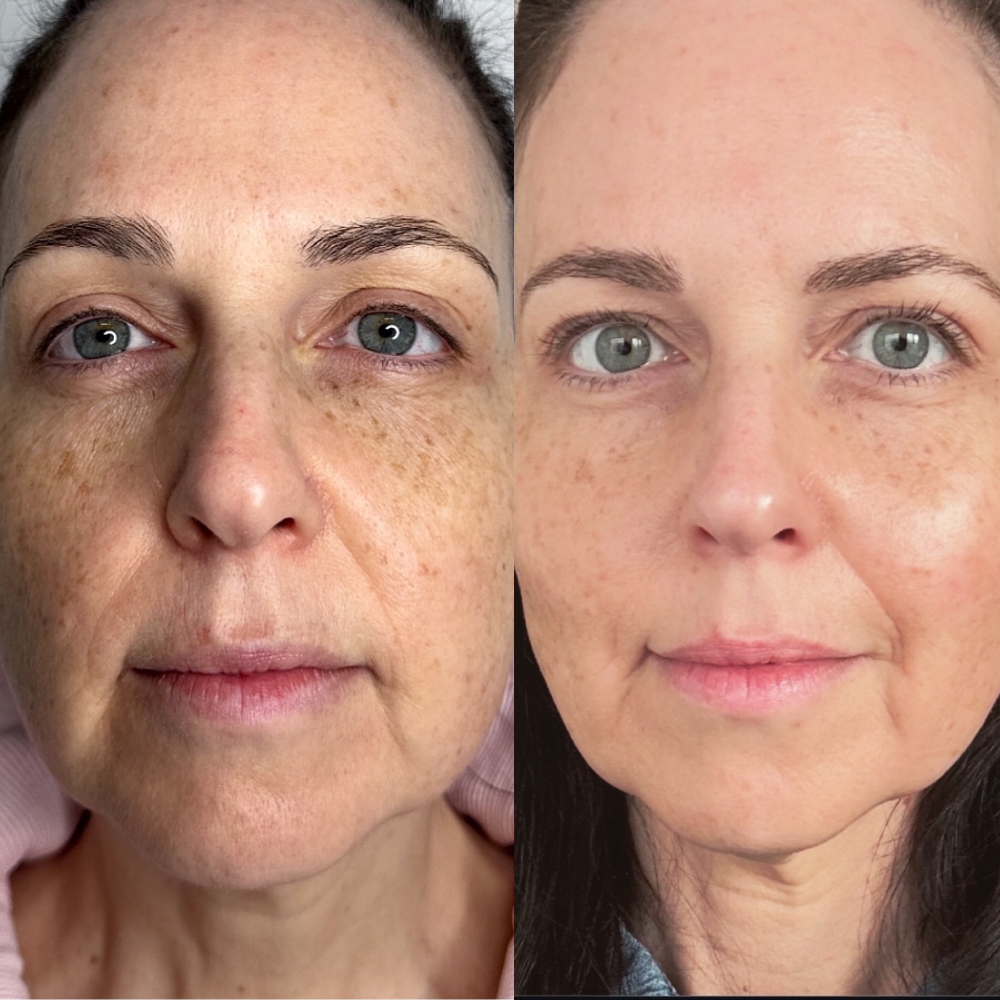 Neogen before and after result