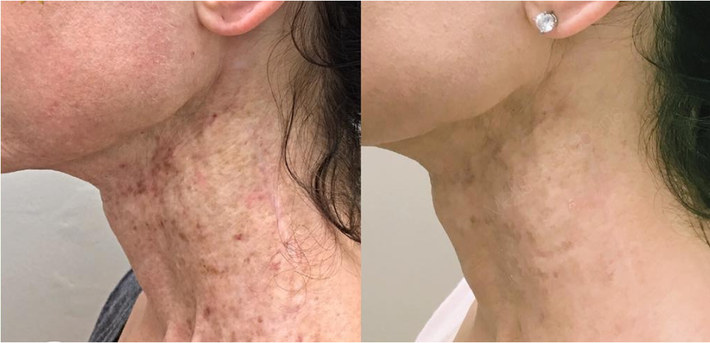 Neogen before and after result