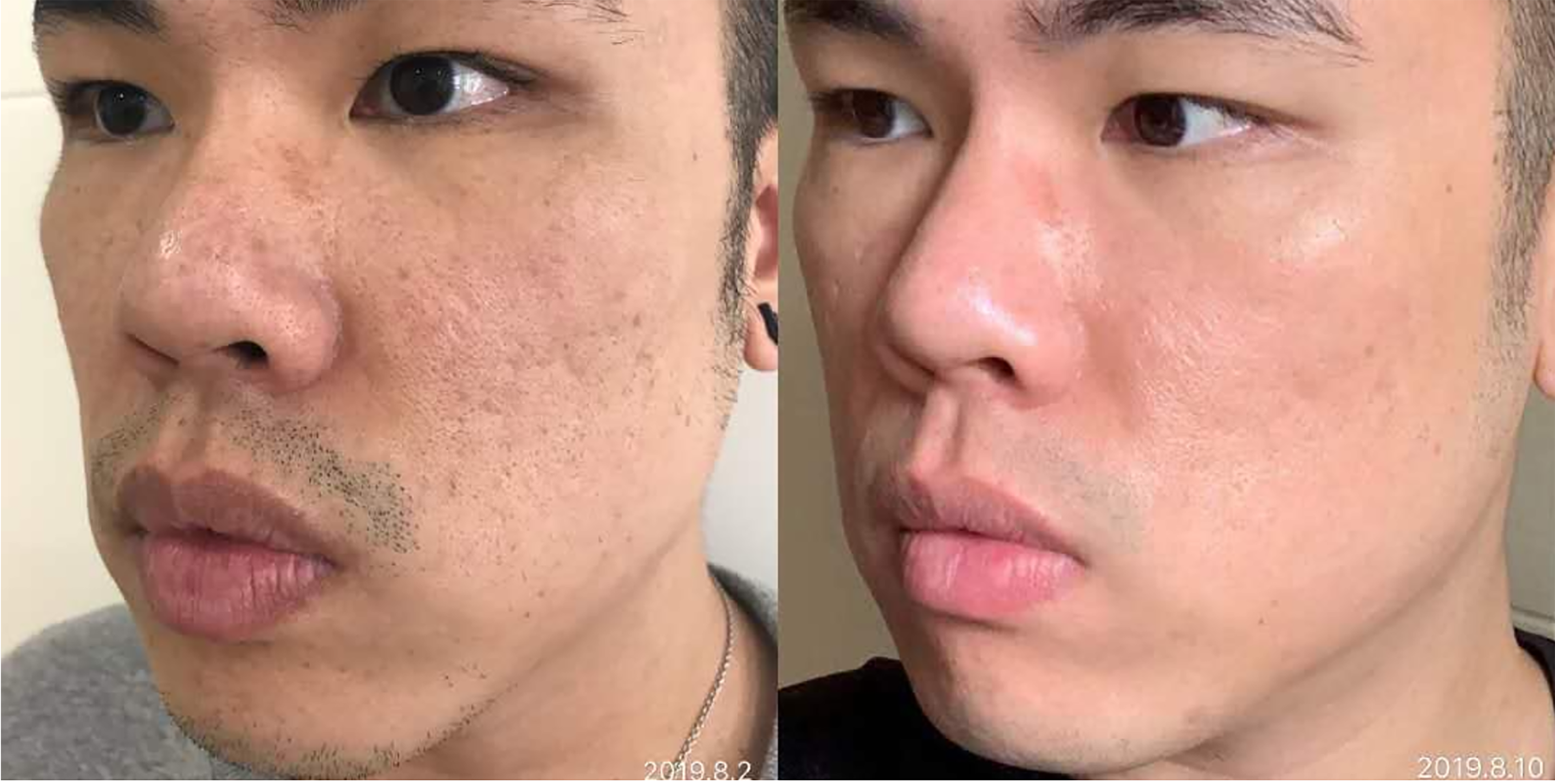 Neogen before and after result