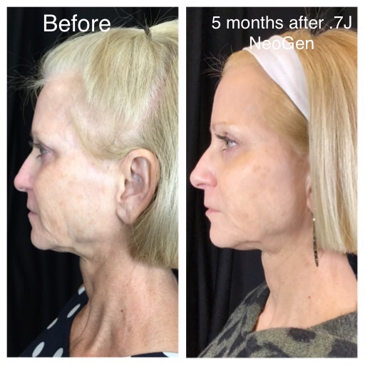 Neogen before and after result