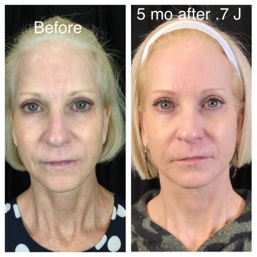Neogen before and after result