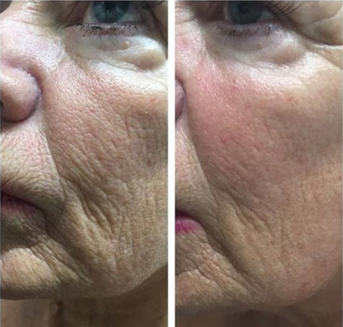 Neogen before and after result