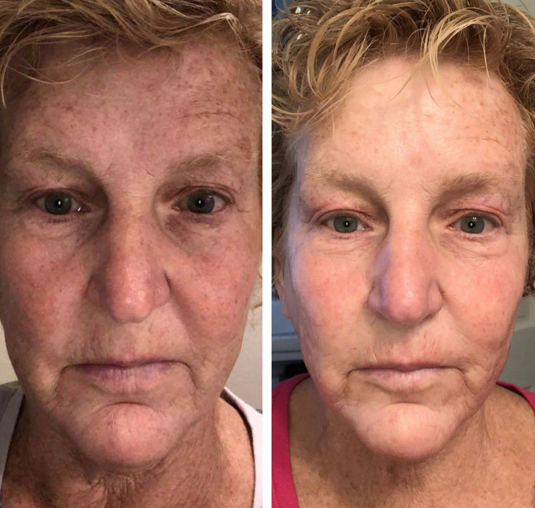 Neogen before and after result