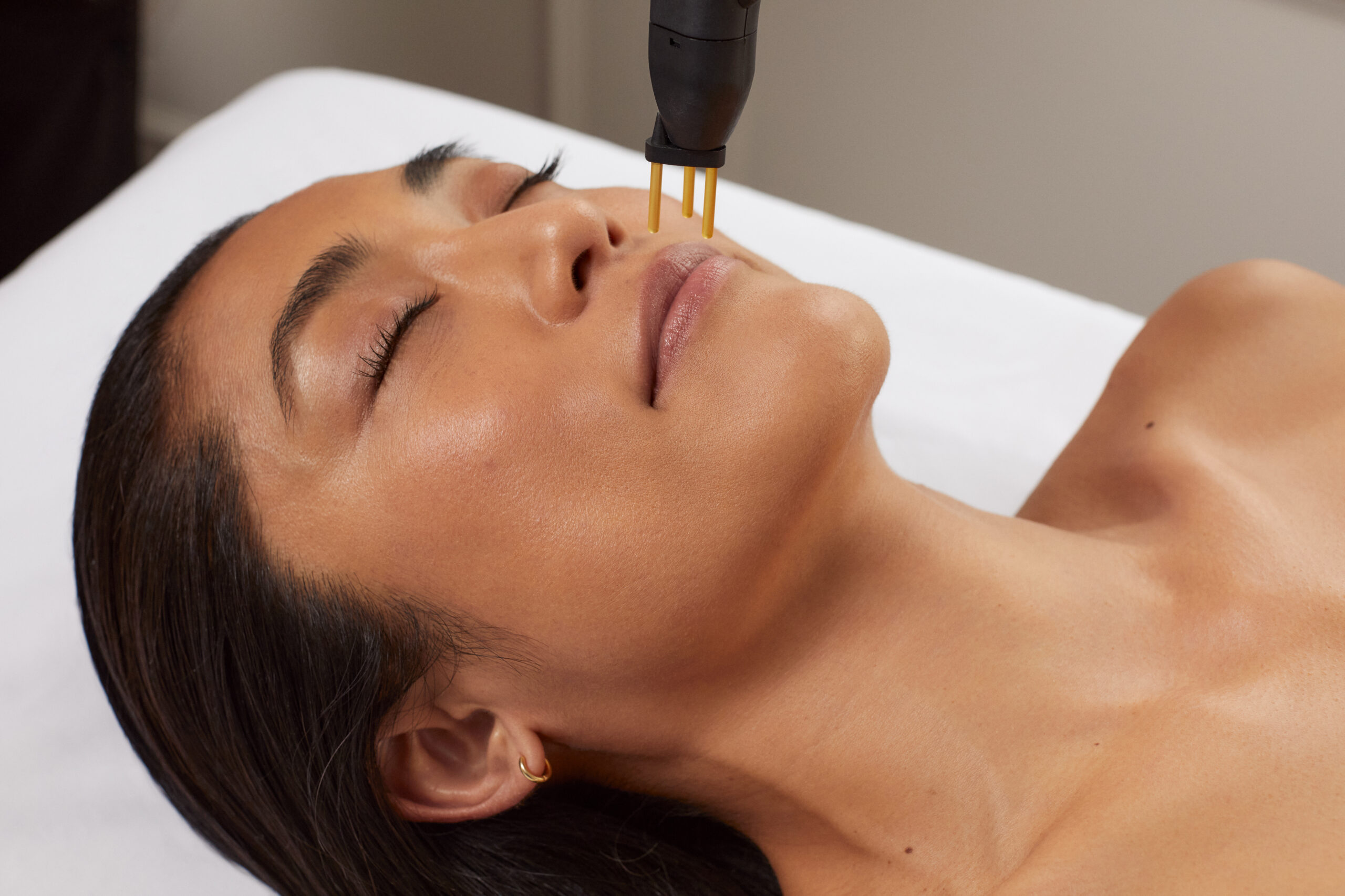 Patient after Neogen nitrogen plasma facial rejuvenation