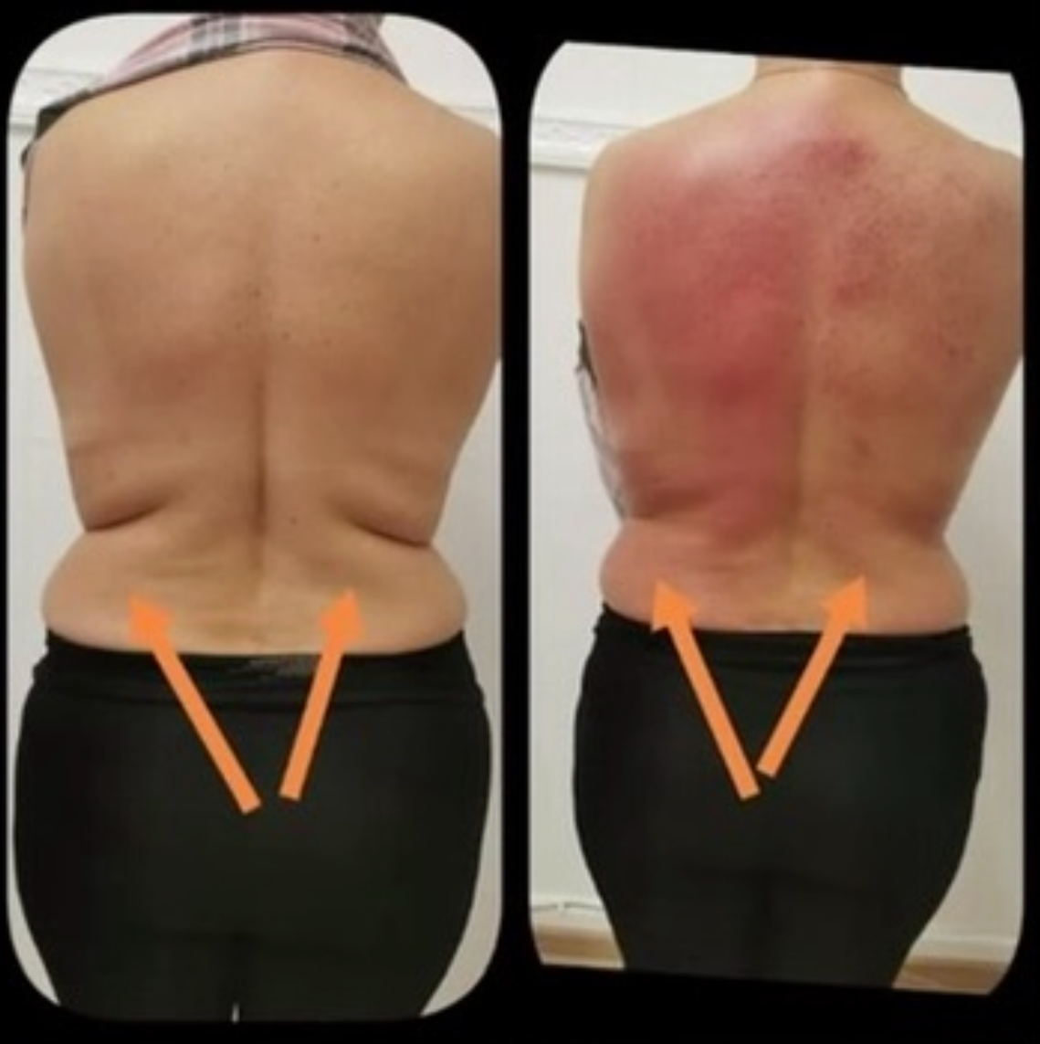 T-Shape 2 result — 1 treatment