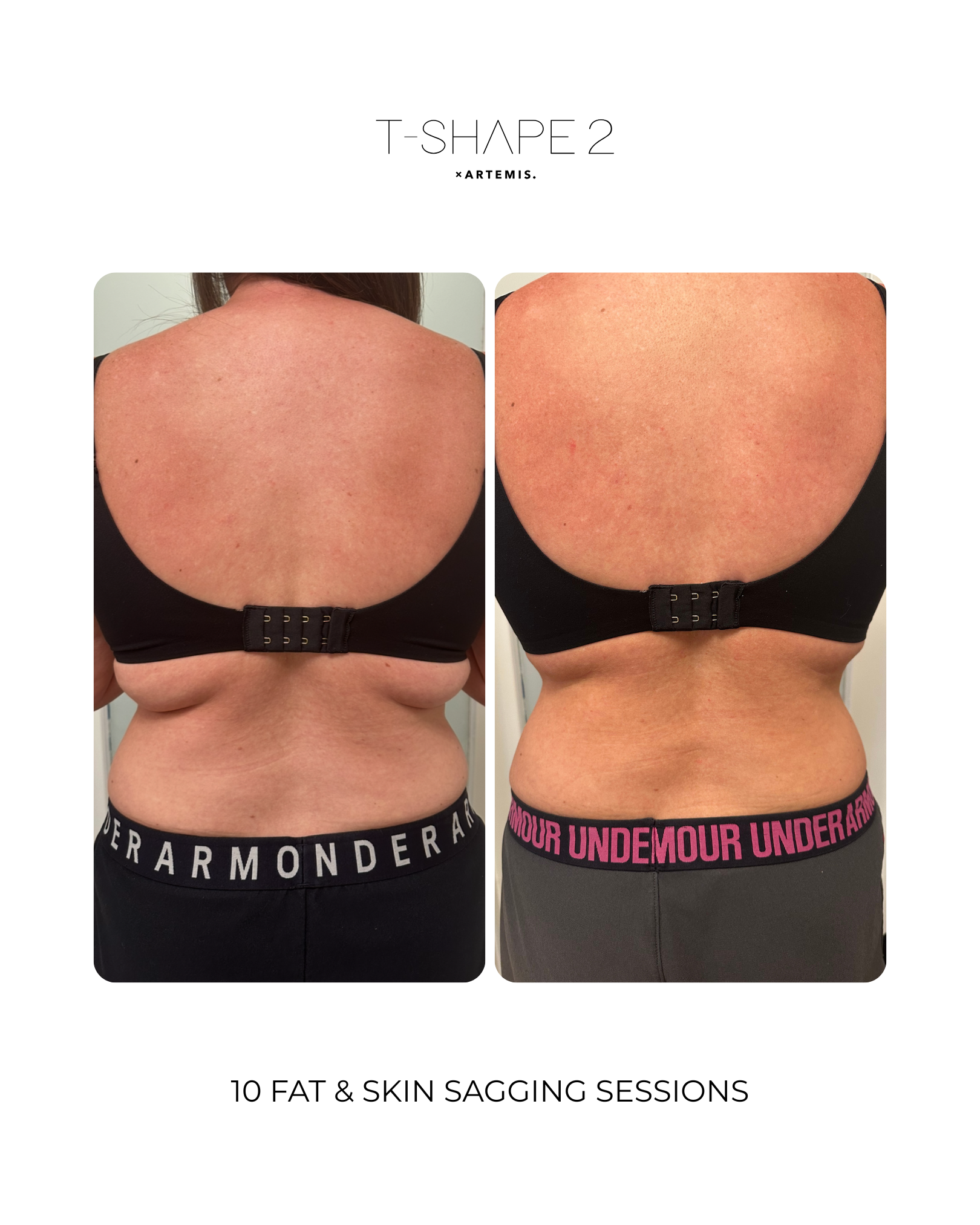 T-Shape 2 result — 10 Sessions of Fat & Skin Sagging
