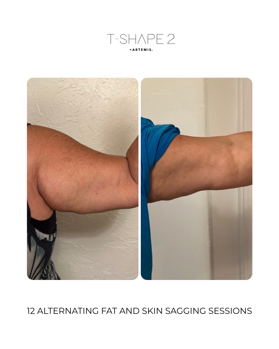 T-Shape 2 result — 12 sessions alternating fat and skin sagging treatments
