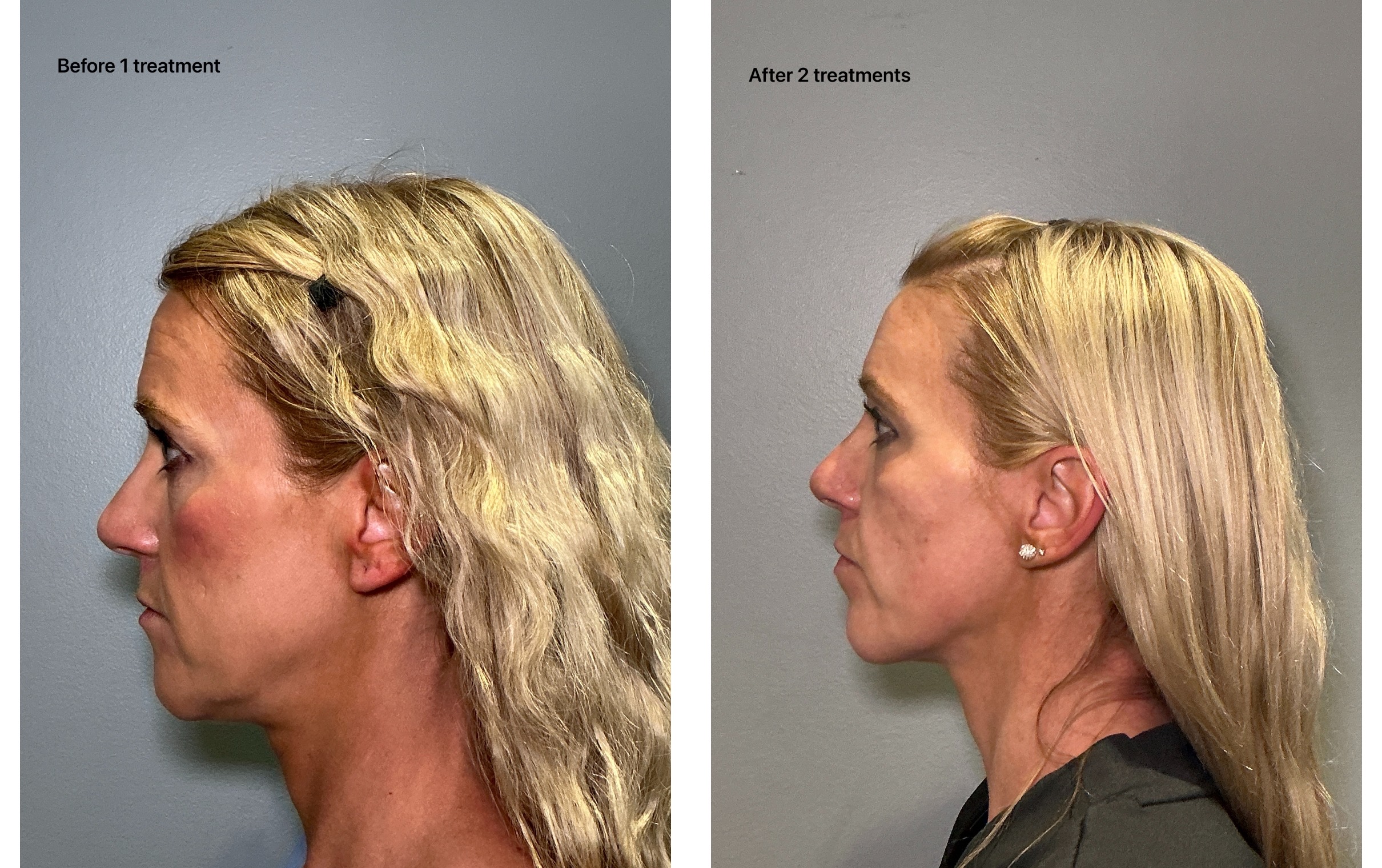 T-Shape 2 result — 2 treatments copy