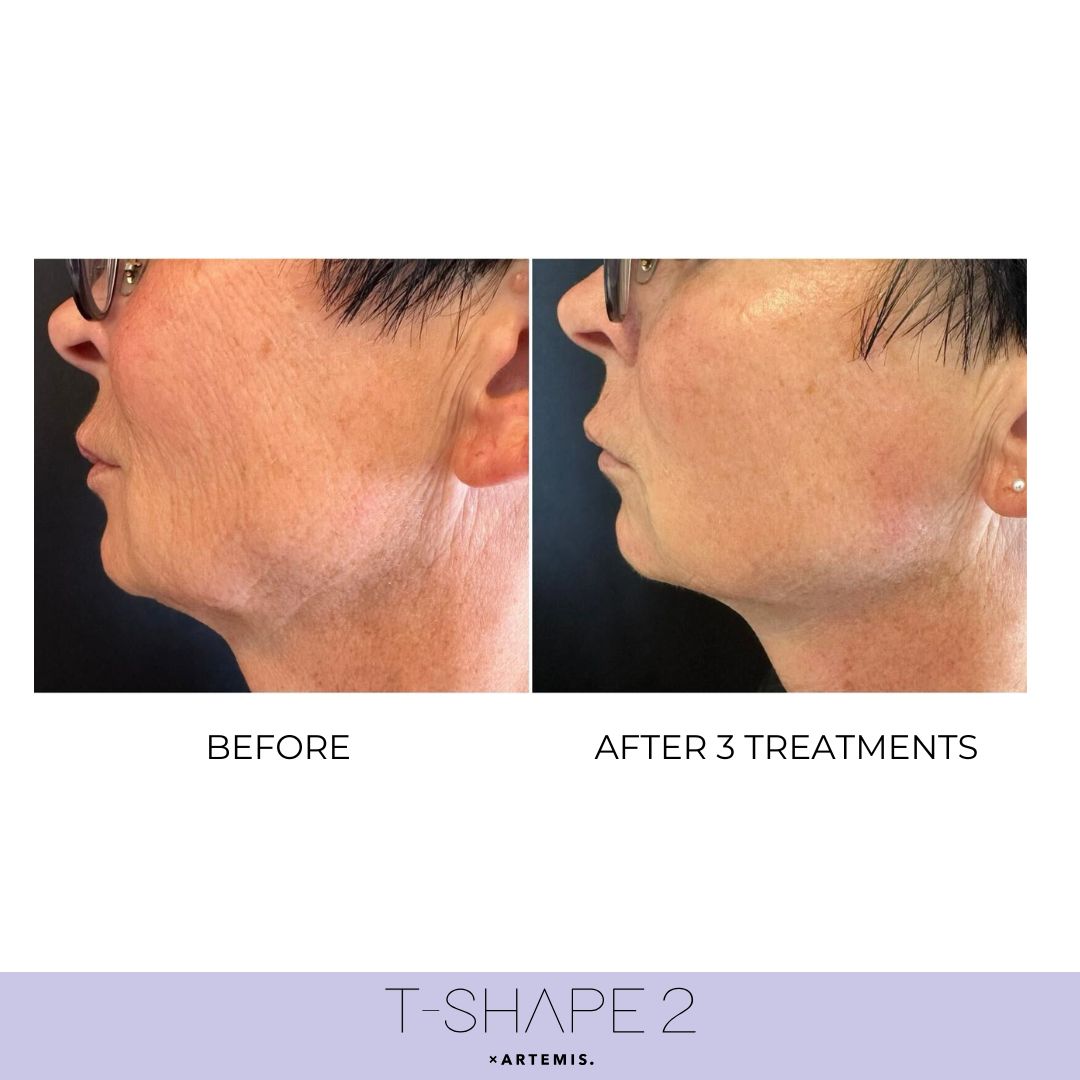 T-Shape 2 result — 2