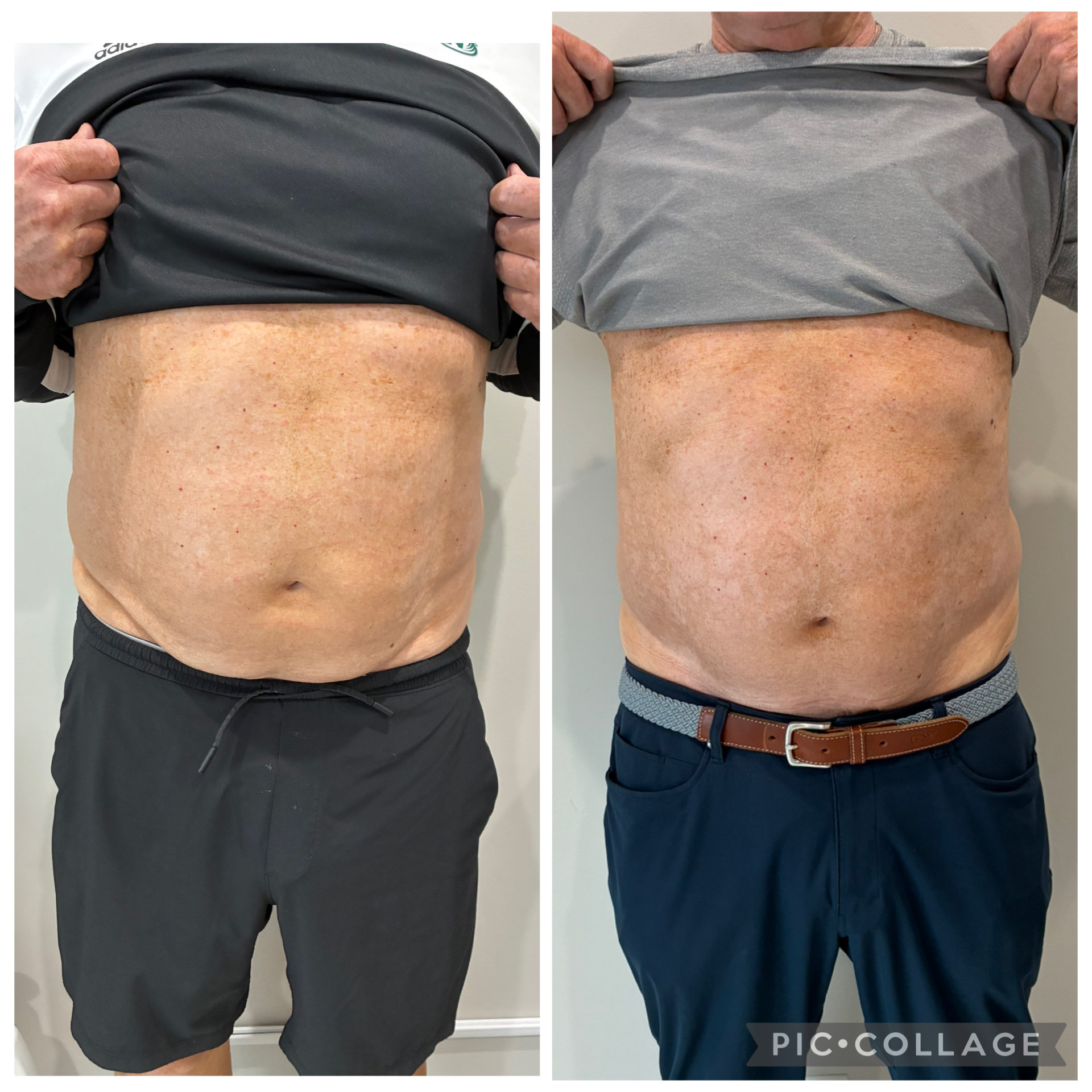 T-Shape 2 result — 3 treatments front (Mary Dugan Aesthetics by Prescription)