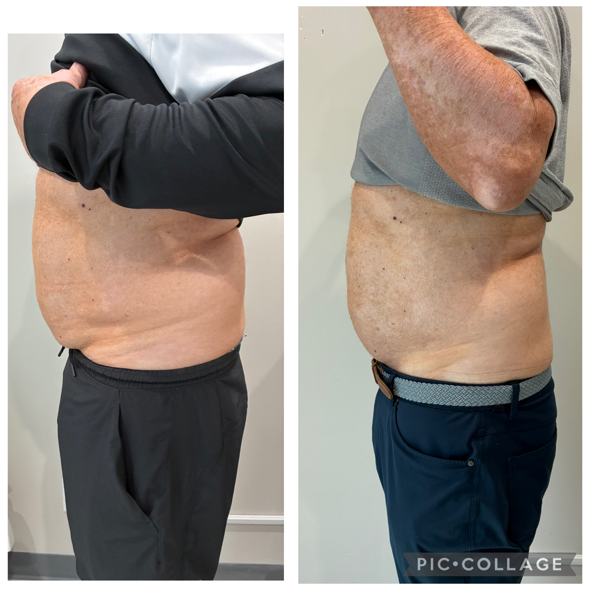 T-Shape 2 result — 3 treatments side 2 (Mary Dugan Aesthetics by Prescription)