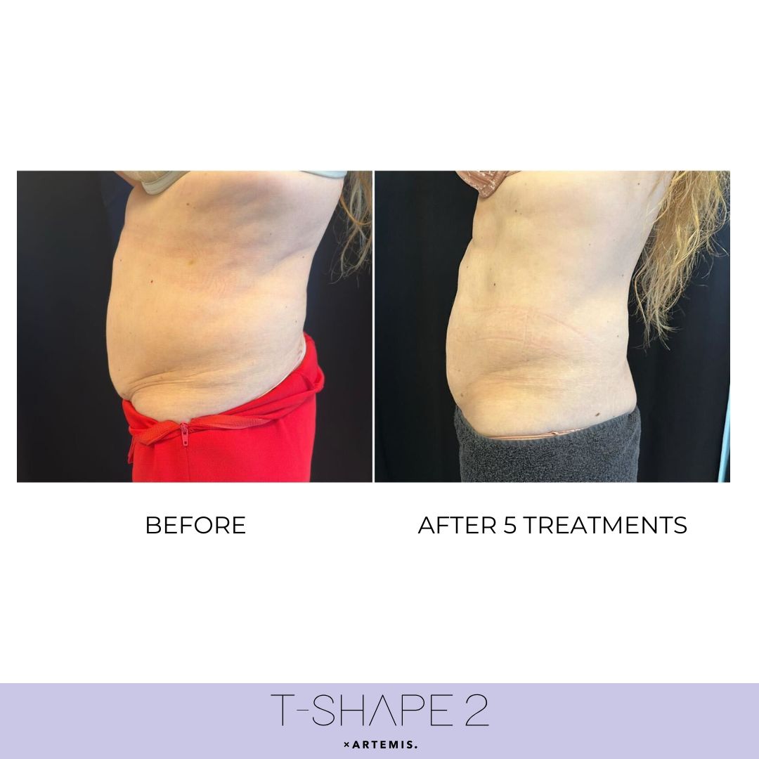 T-Shape 2 result — 4