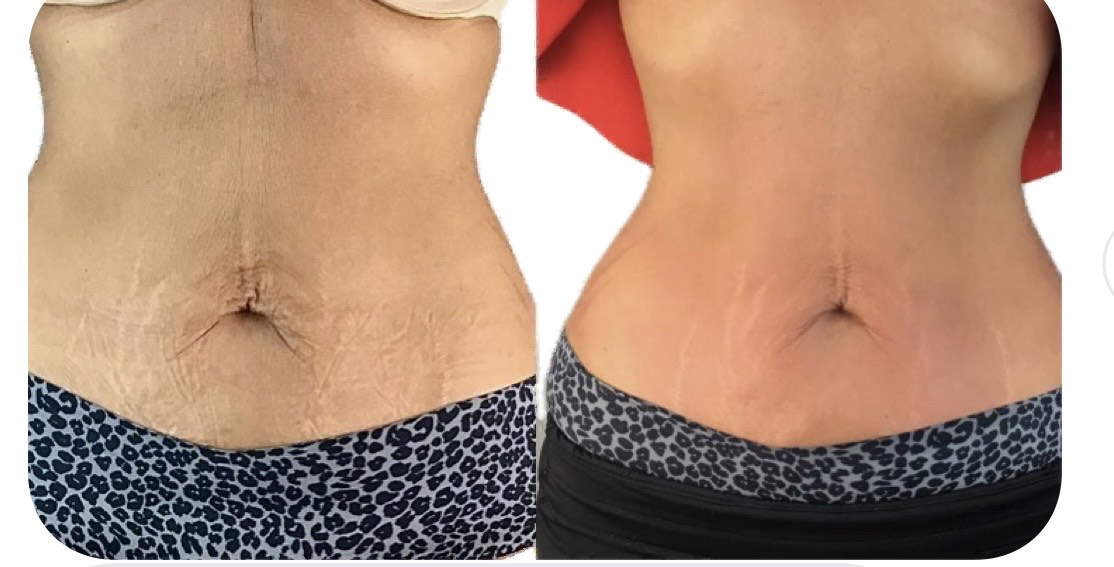 T-Shape 2 result — 6 treatments Becking Wellness