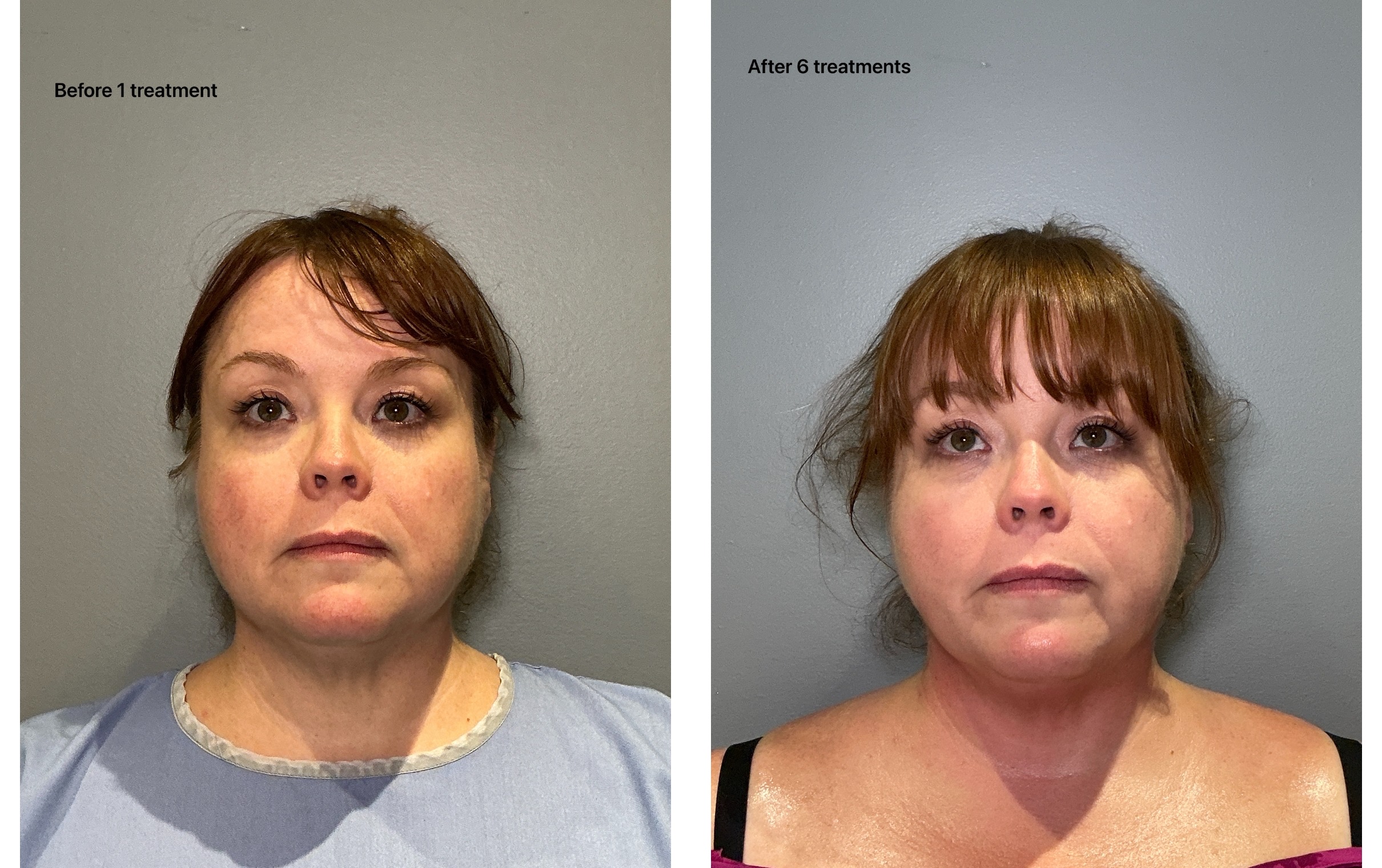 T-Shape 2 result — 6 treatments copy