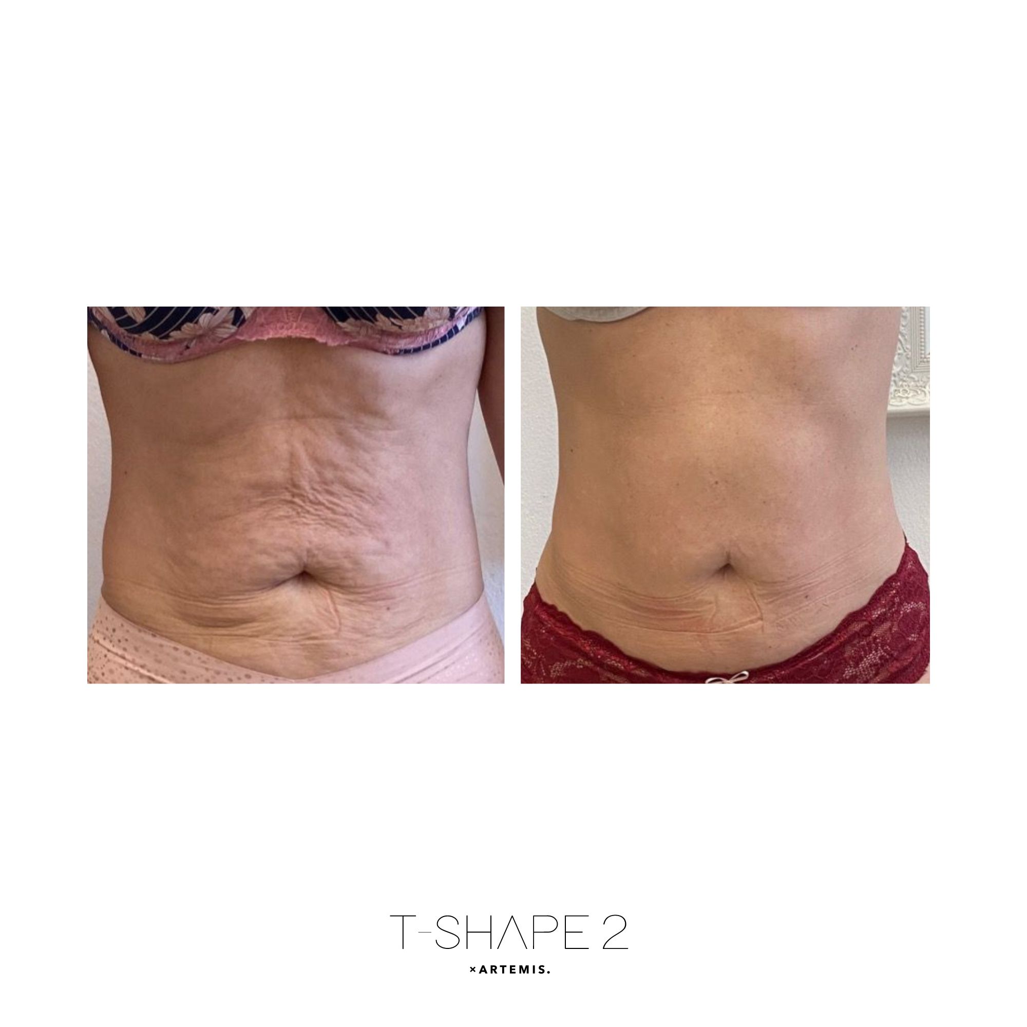 T-Shape 2 result — Abs 2