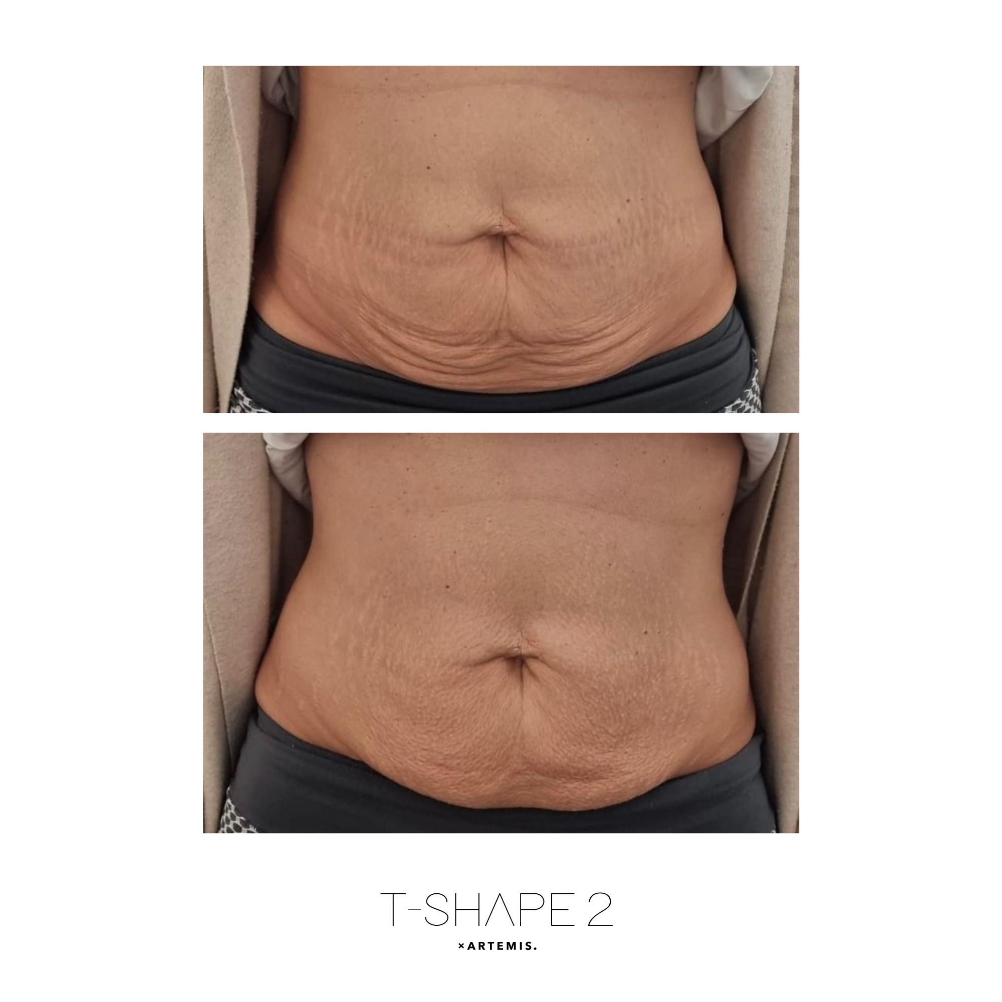 T-Shape 2 result — Abs 3