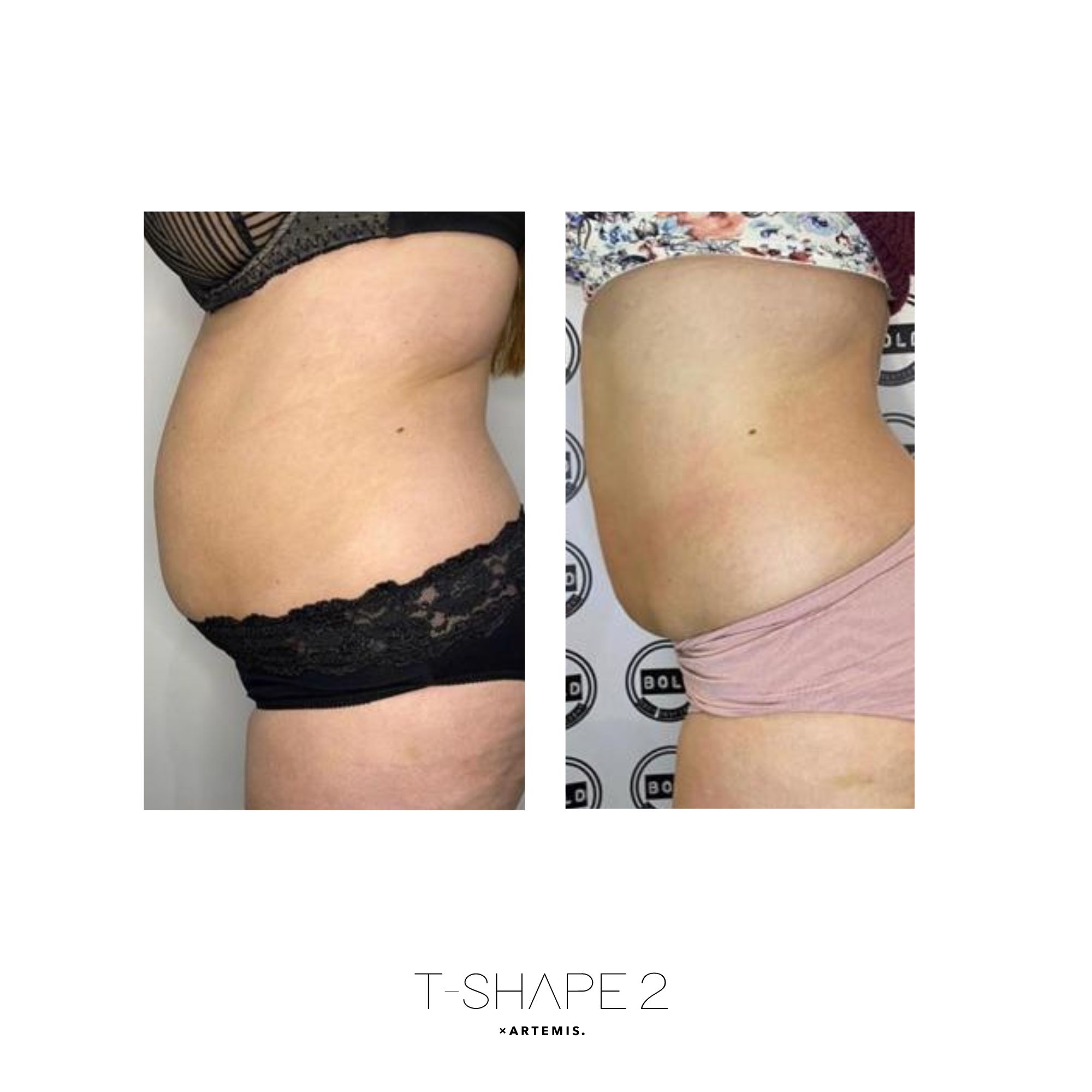 T-Shape 2 result — Abs 4