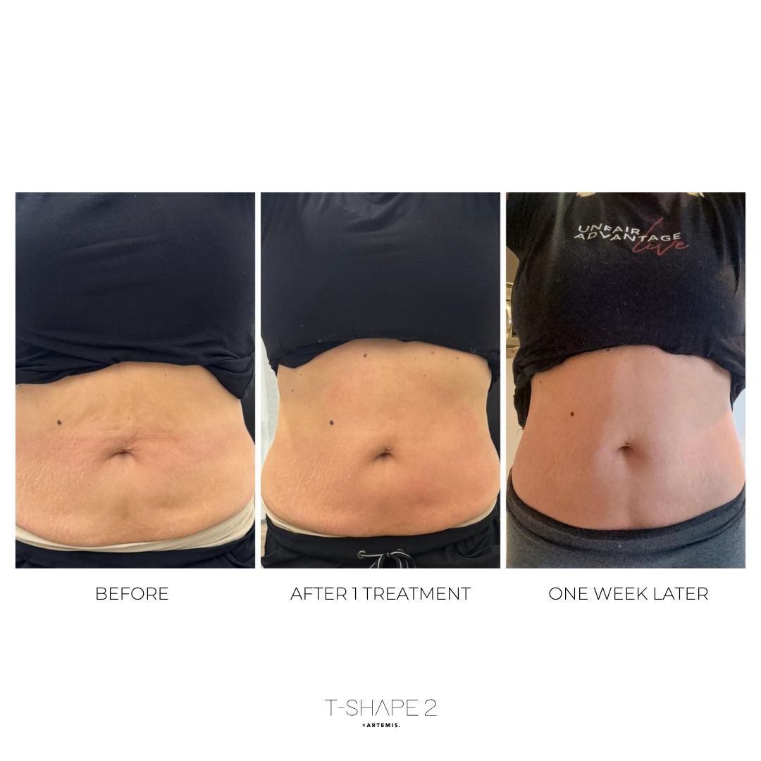 T-Shape 2 result — After 1 treatment copy