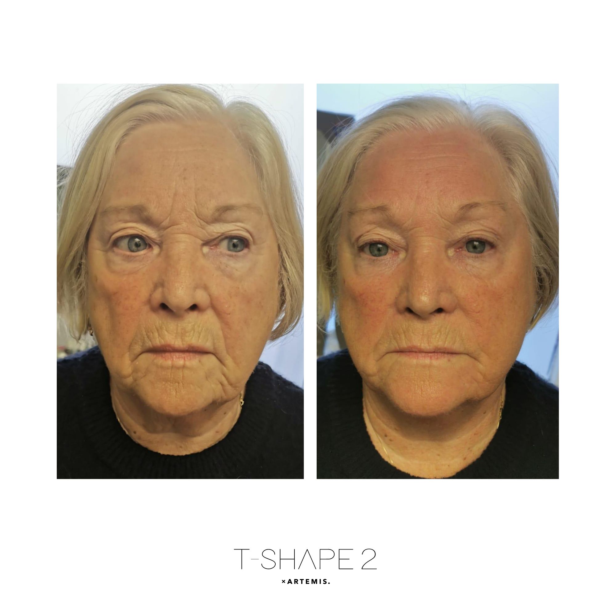 T-Shape 2 result — After 1 treatment