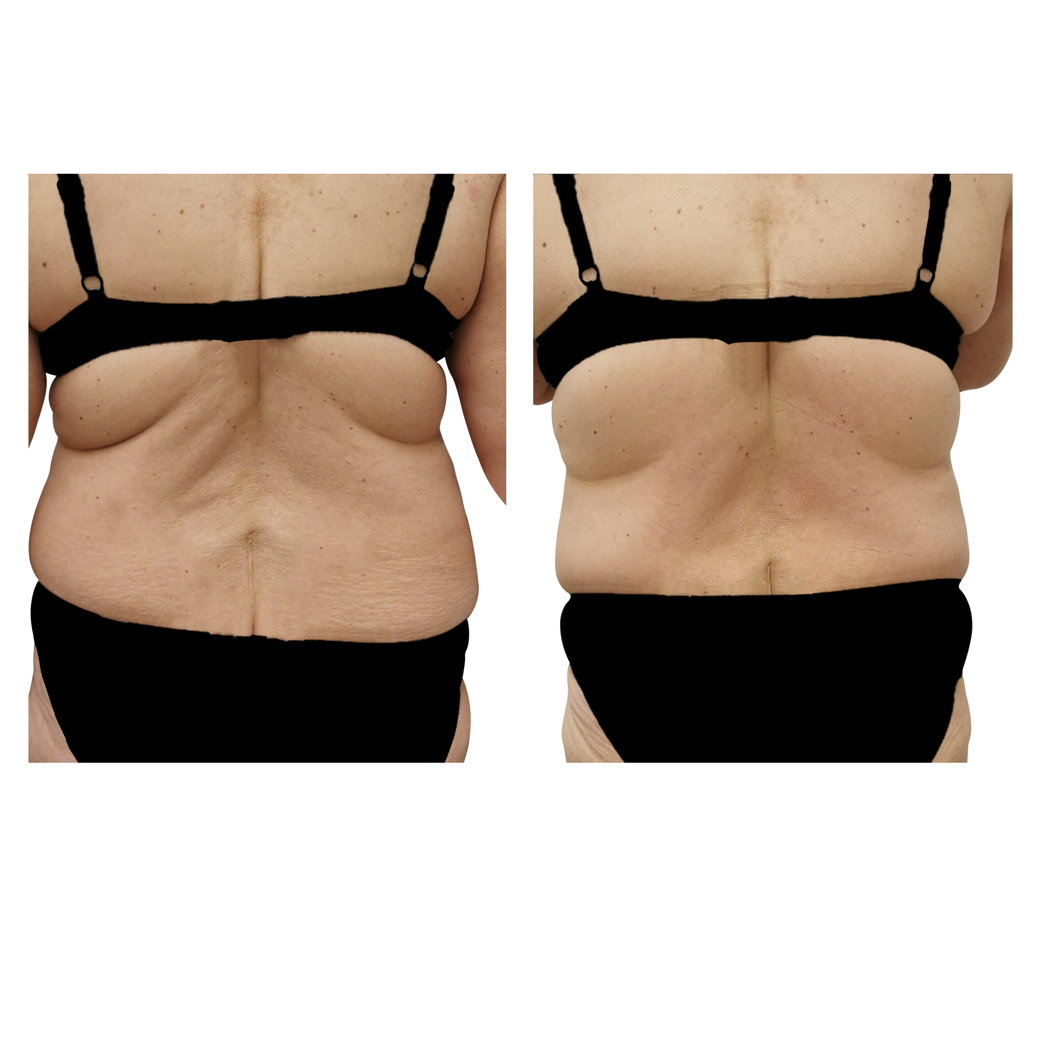 T-Shape 2 result — After 10 treatments
