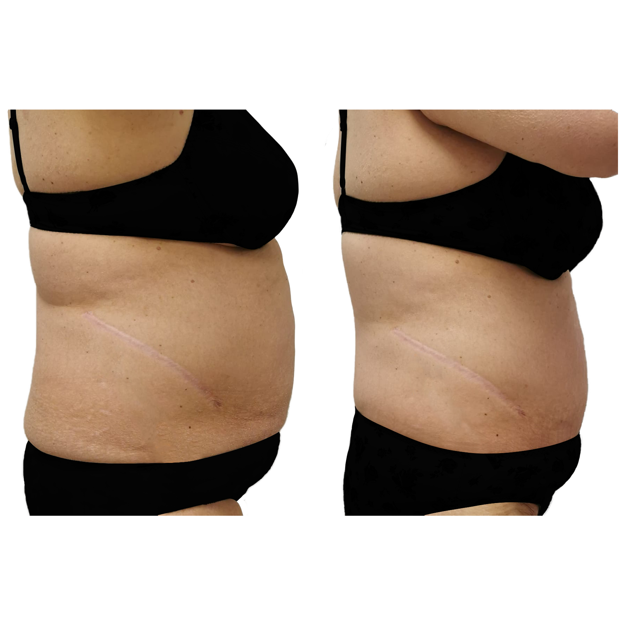 T-Shape 2 result — After 10 treatments 2