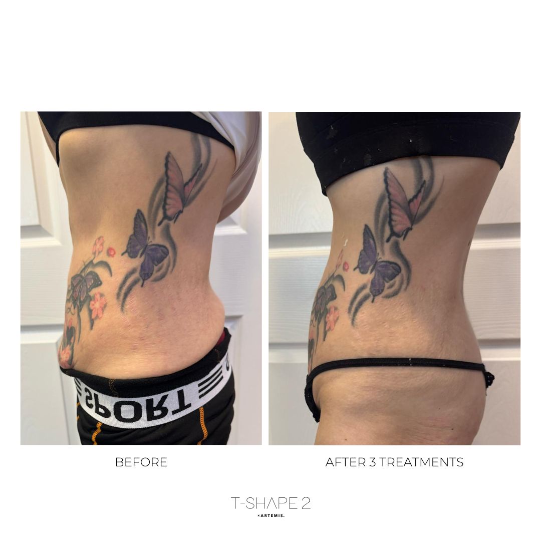 T-Shape 2 result — After 3 treatments (2)