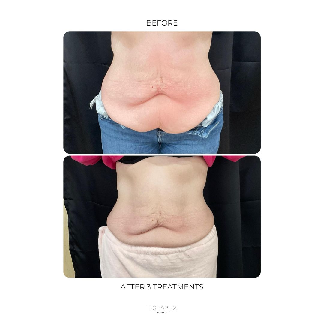 T-Shape 2 result — After 3 treatments (3)