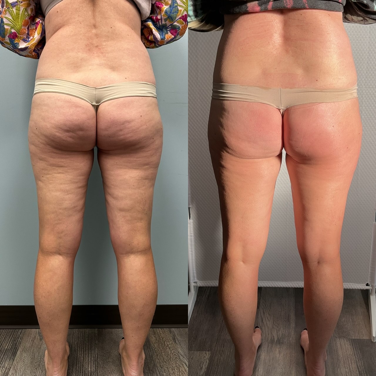 T-Shape 2 result — After 3 treatments (back)