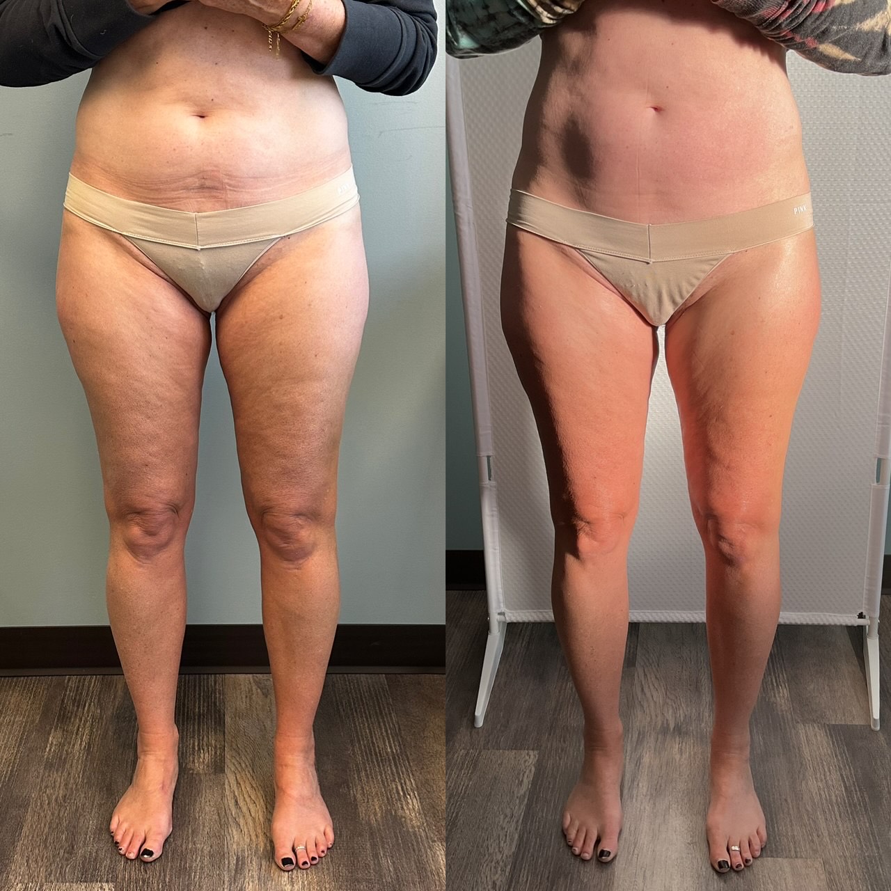 T-Shape 2 result — After 3 treatments (front)