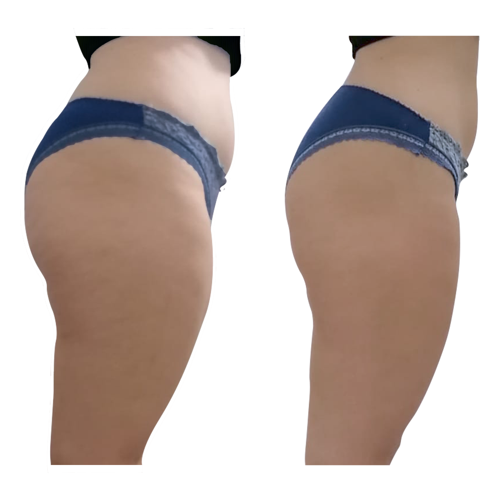 T-Shape 2 result — After 3 treatments (side 1)