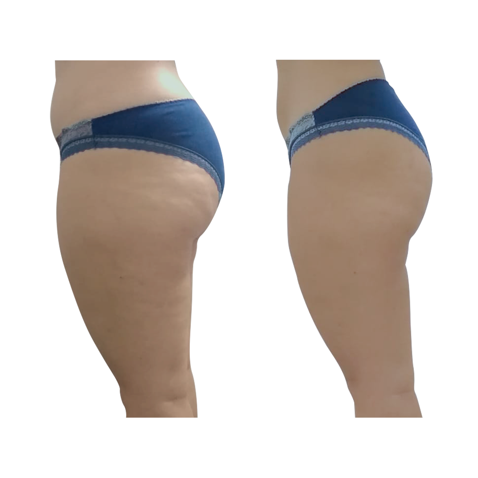 T-Shape 2 result — After 3 treatments (side 2)