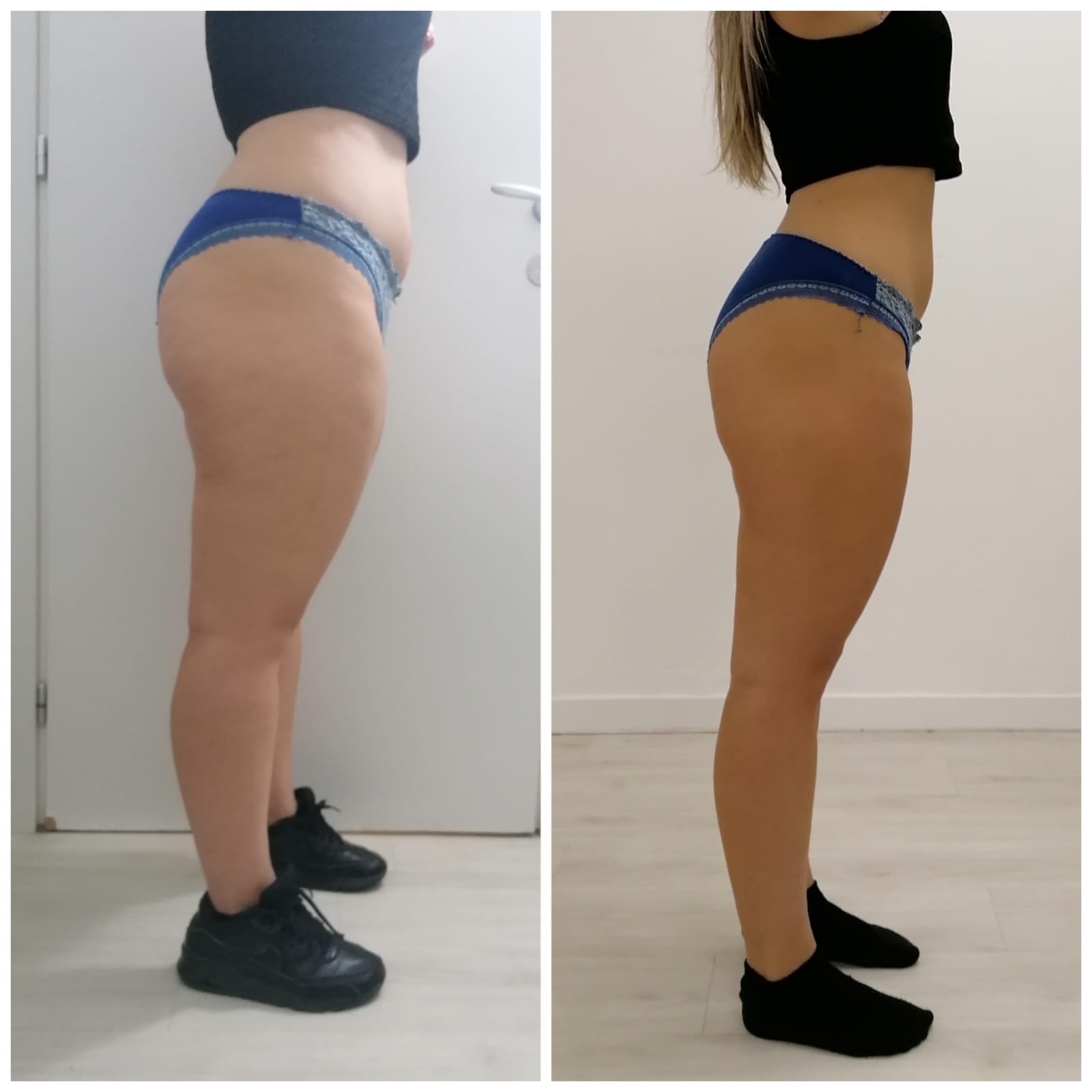 T-Shape 2 result — After 3 treatments