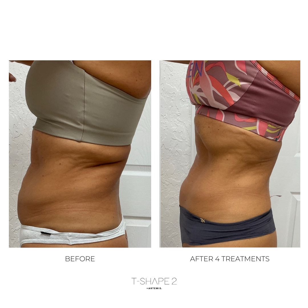 T-Shape 2 result — After 4 treatments (2)