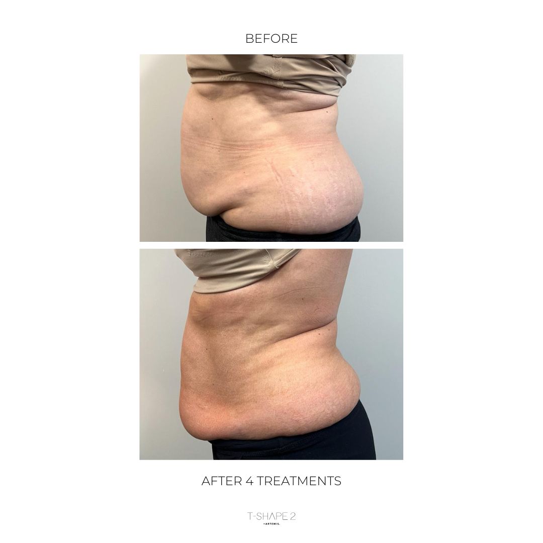 T-Shape 2 result — After 4 treatments copy