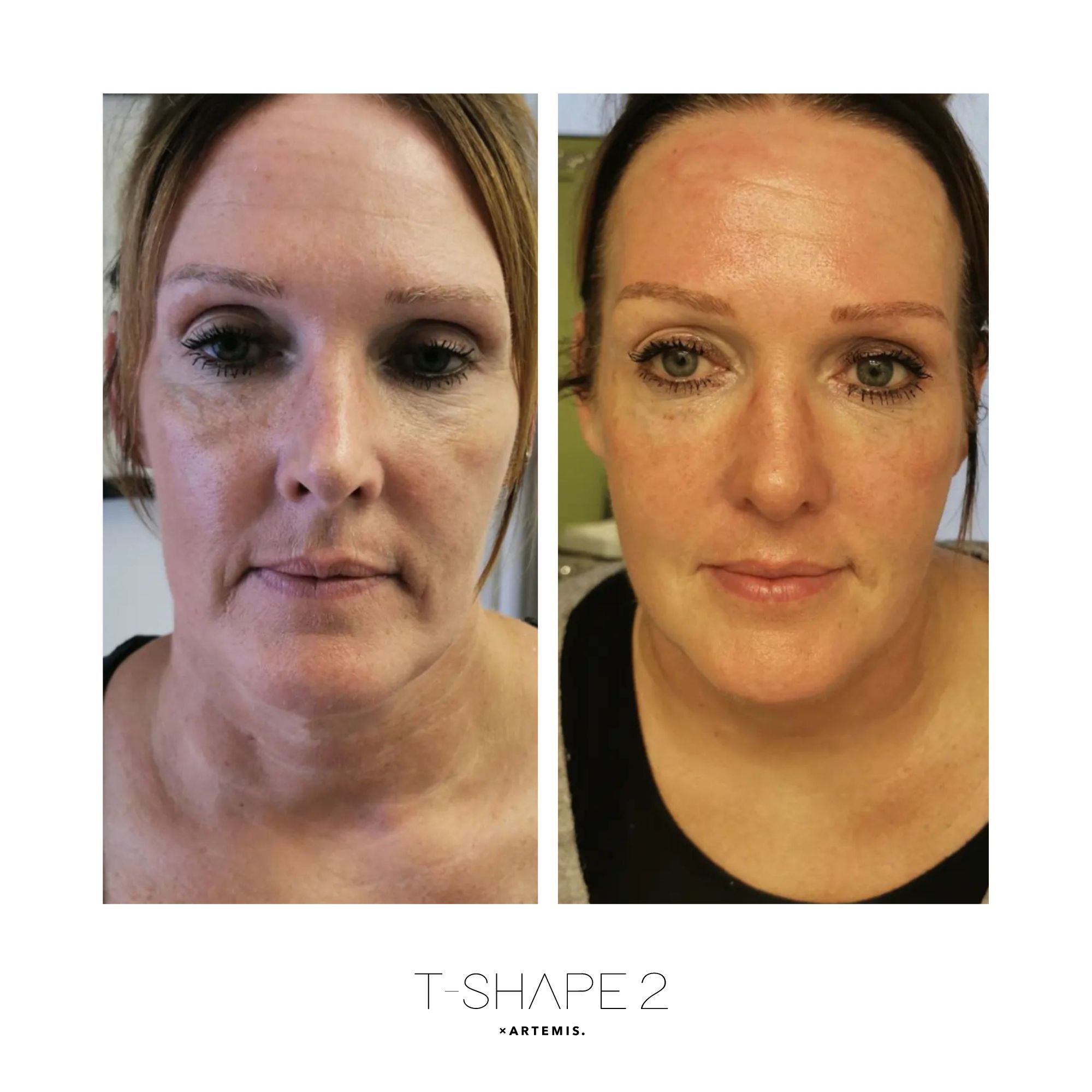 T-Shape 2 result — After 4 treatments