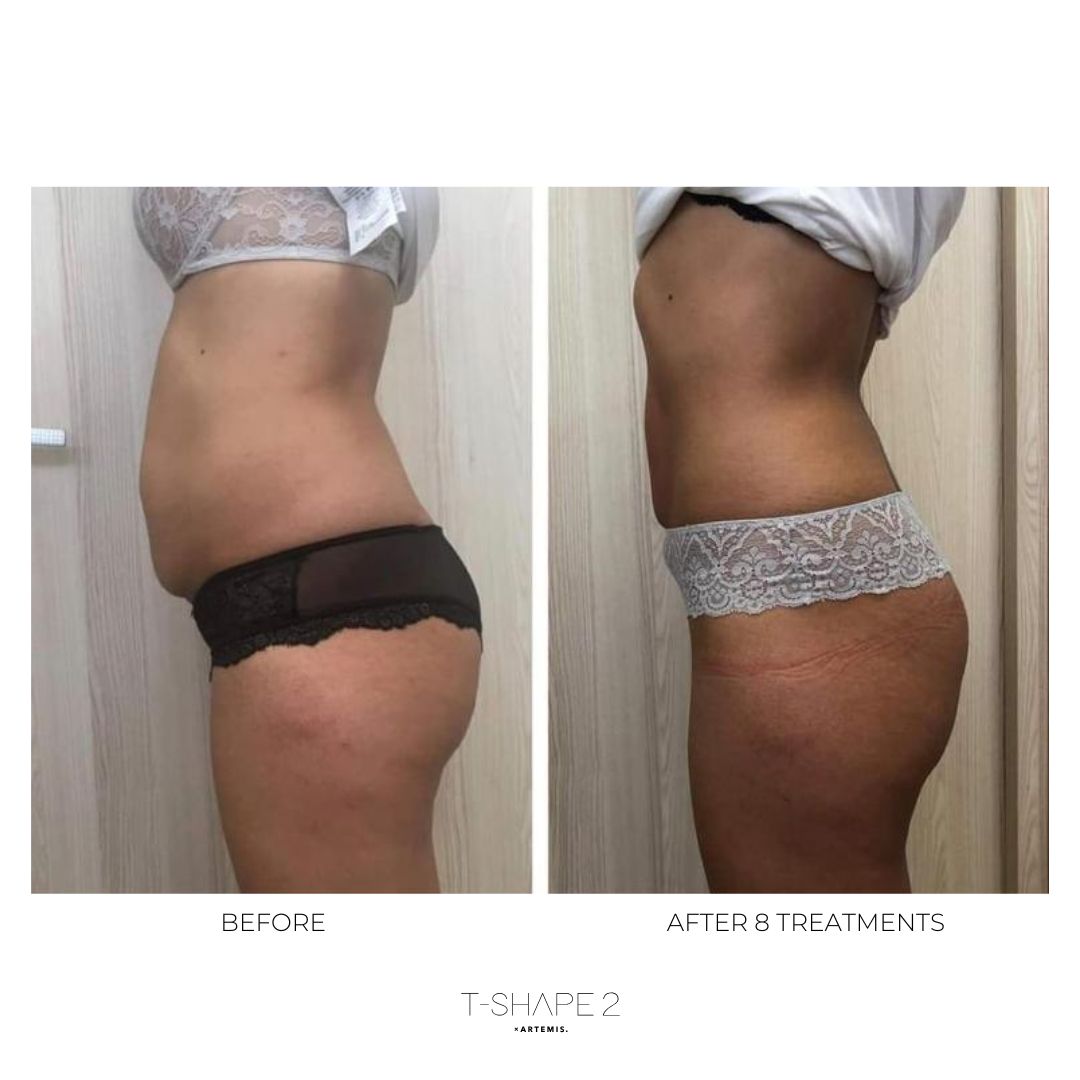 T-Shape 2 result — After 8 treatments (2)