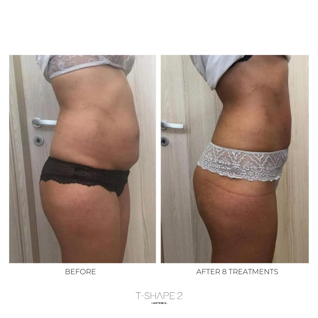 T-Shape 2 result — After 8 treatments