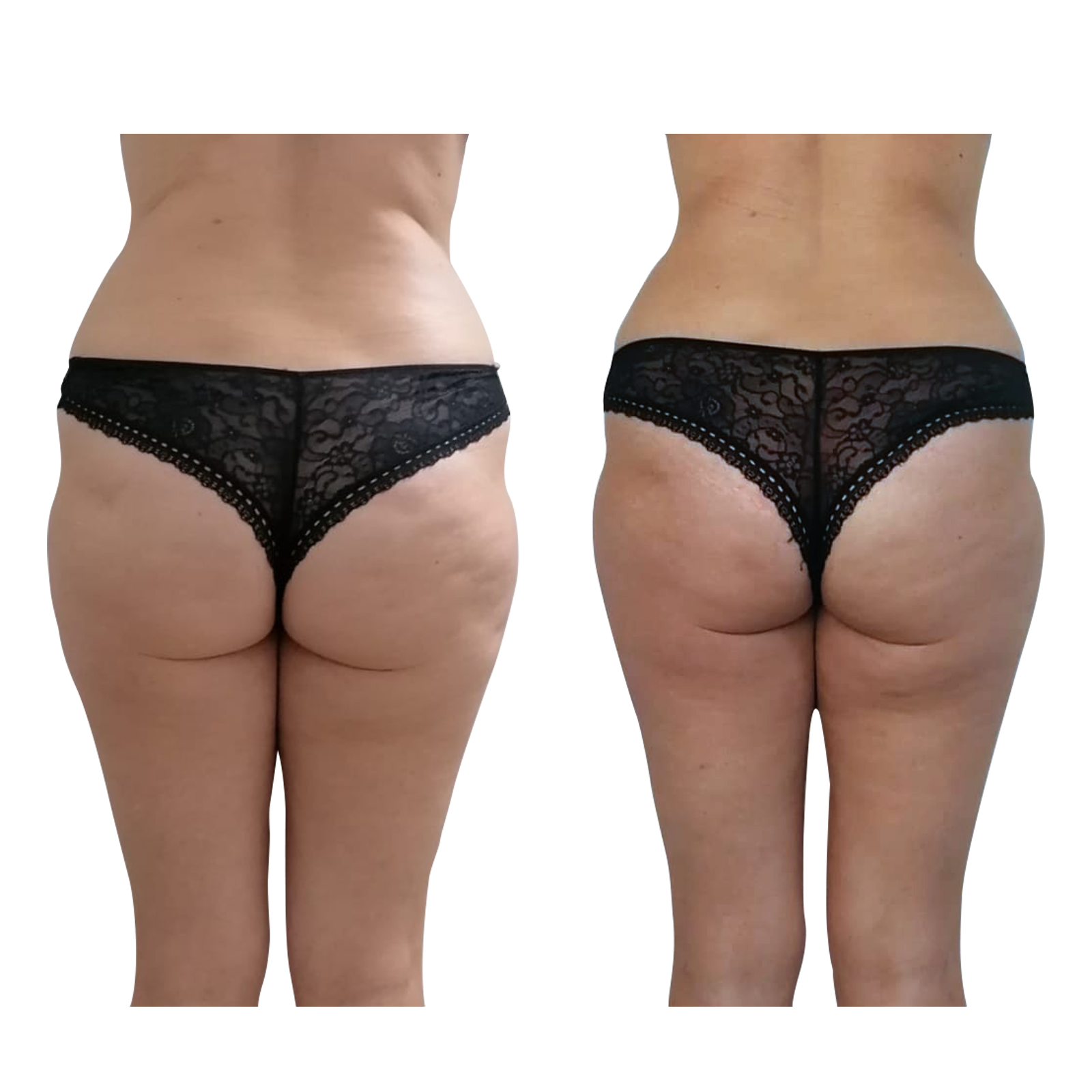 T-Shape 2 result — After 8 treatments