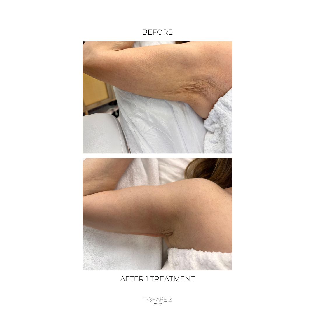 T-Shape 2 result — B&A 1 TREATMENT ARMS