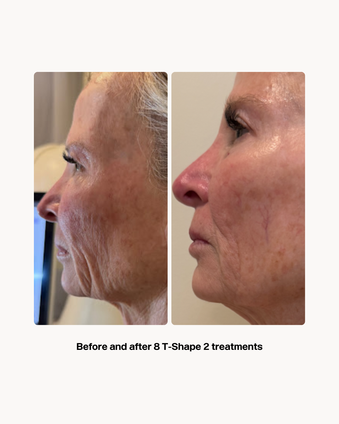 T-Shape 2 result — Before and After T Shape 2 Treatments (1)
