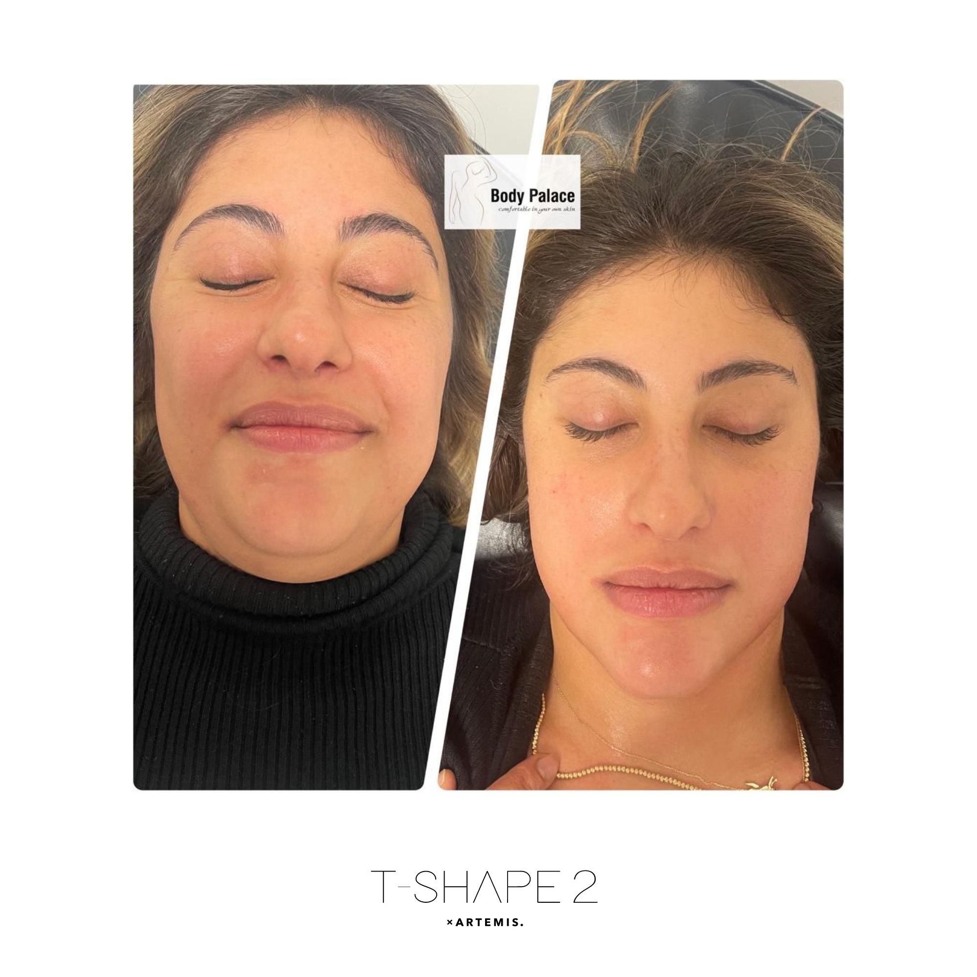 T-Shape 2 result — Face 1