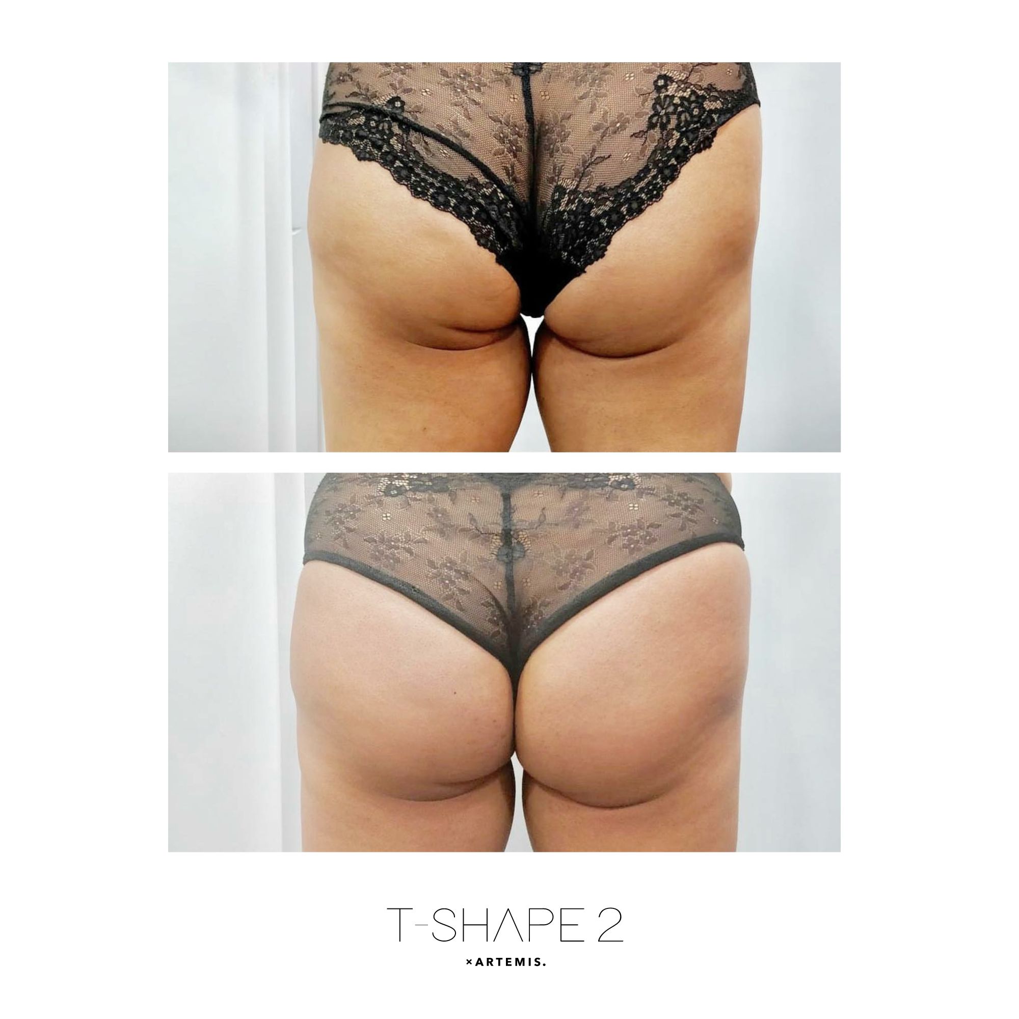 T-Shape 2 result — Glutes 1
