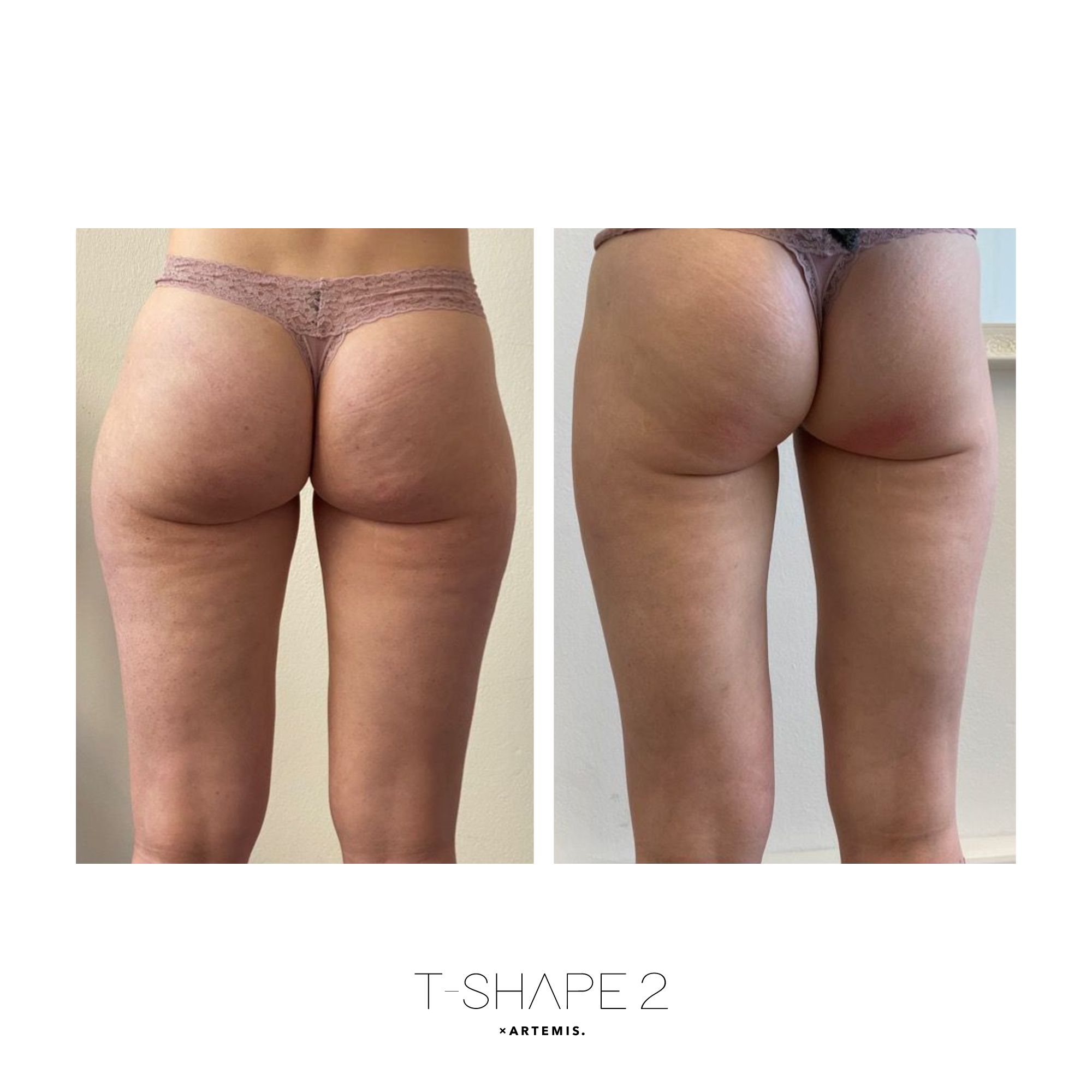 T-Shape 2 result — Glutes 2
