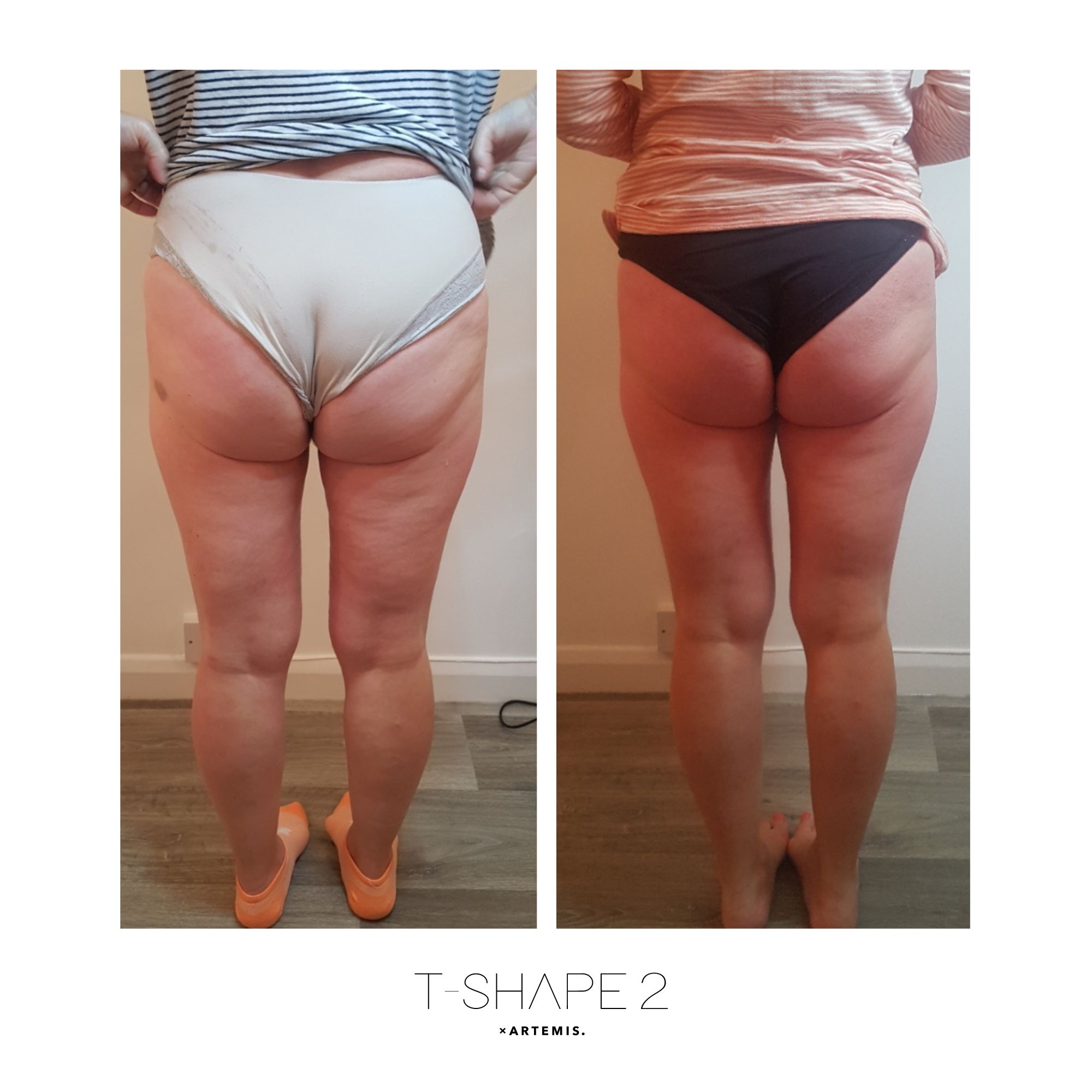 T-Shape 2 result — Legs 1