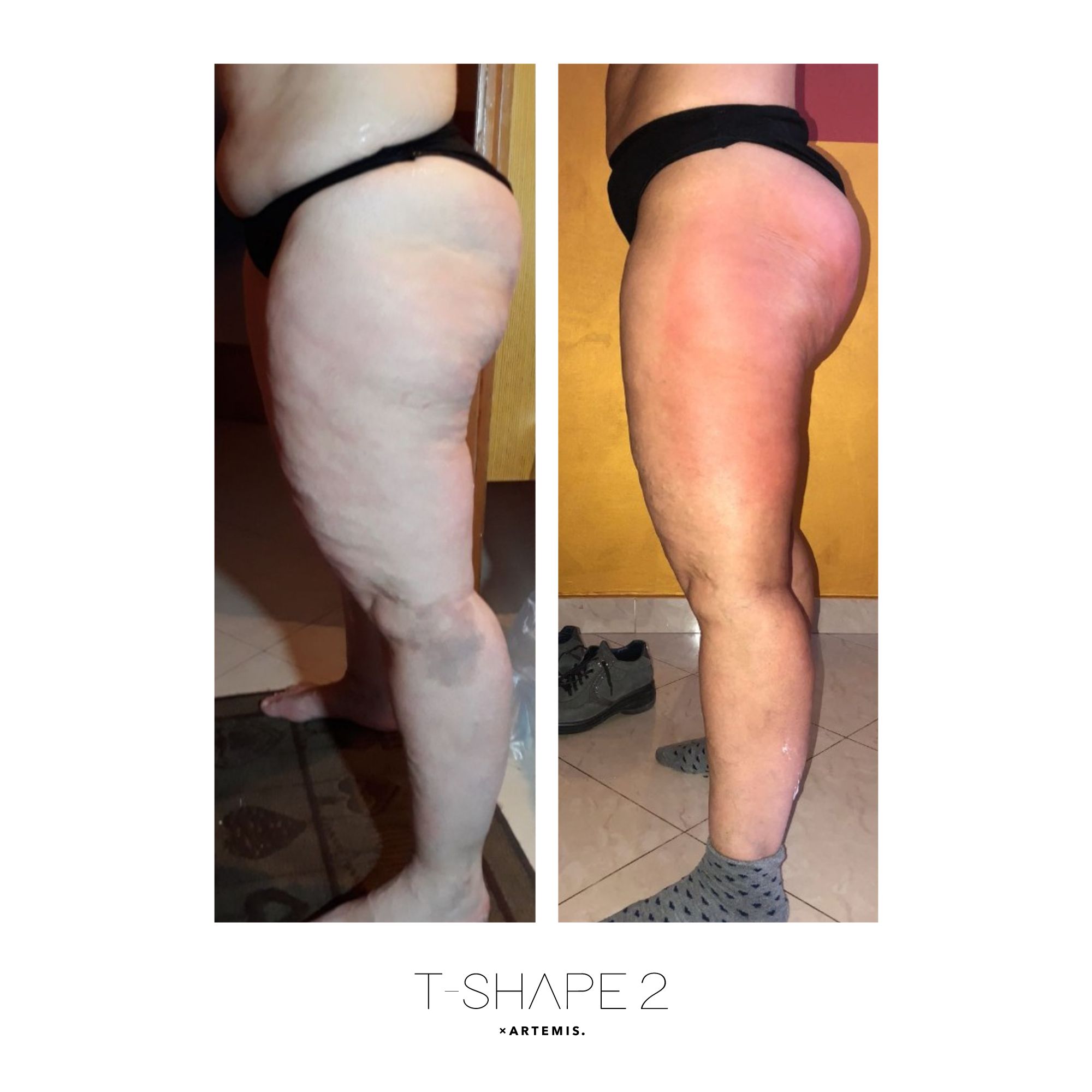 T-Shape 2 result — Legs 2