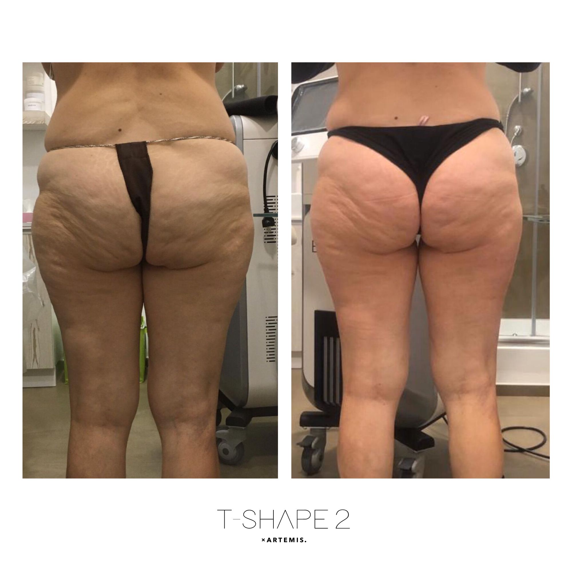 T-Shape 2 result — Legs 4
