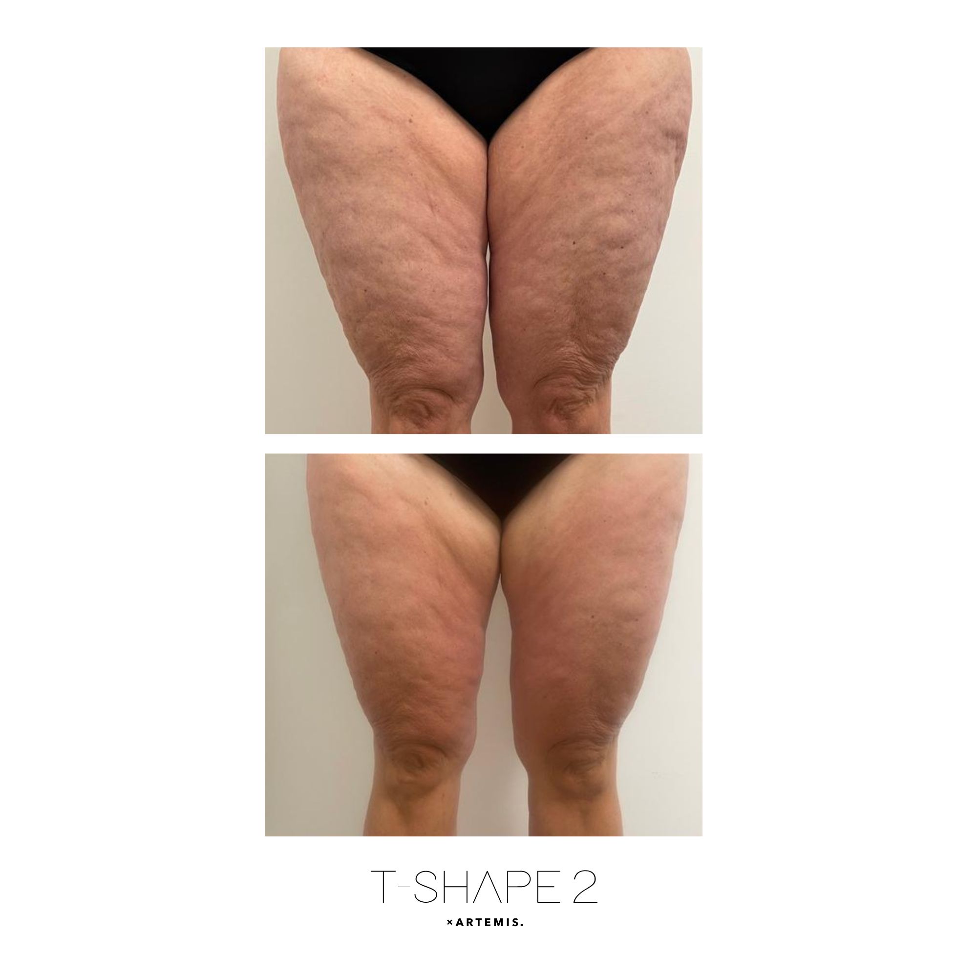 T-Shape 2 result — Legs 5