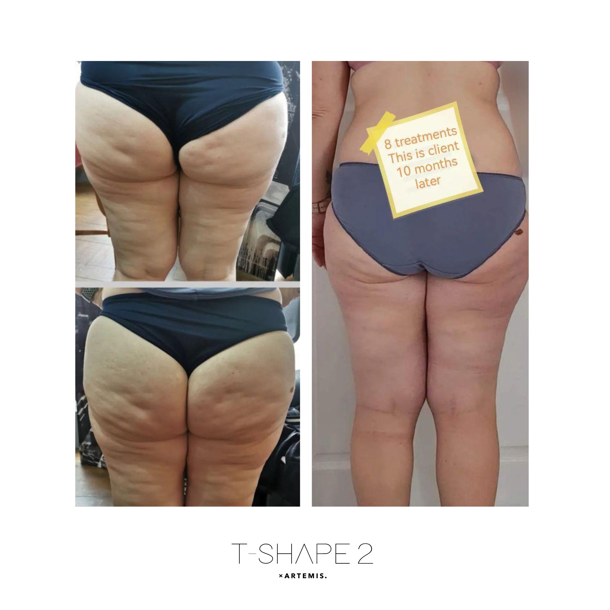 T-Shape 2 result — Legs 6