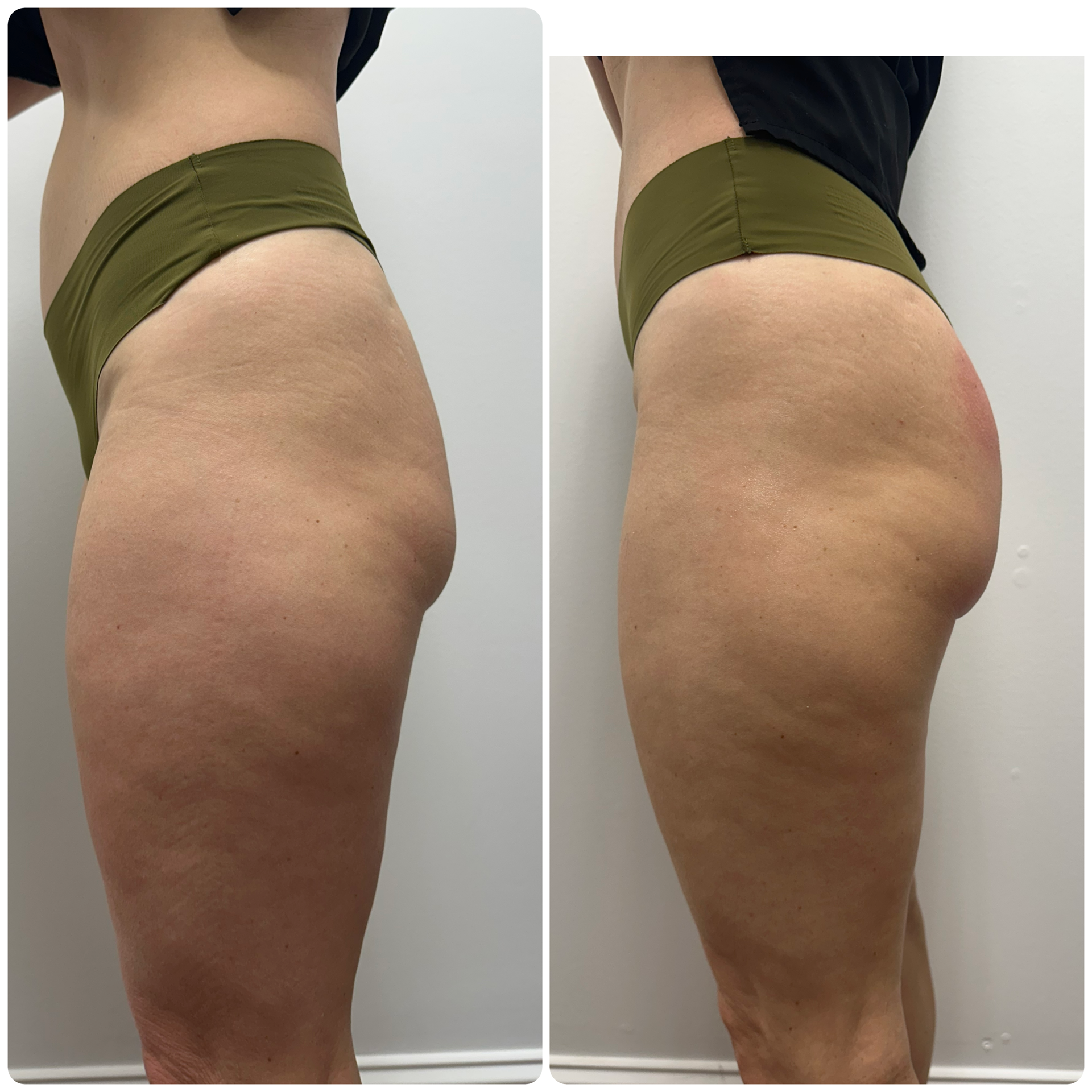 T-Shape 2 result — Soft Cellulite Protocol followed by Mesosphere glute lifting.