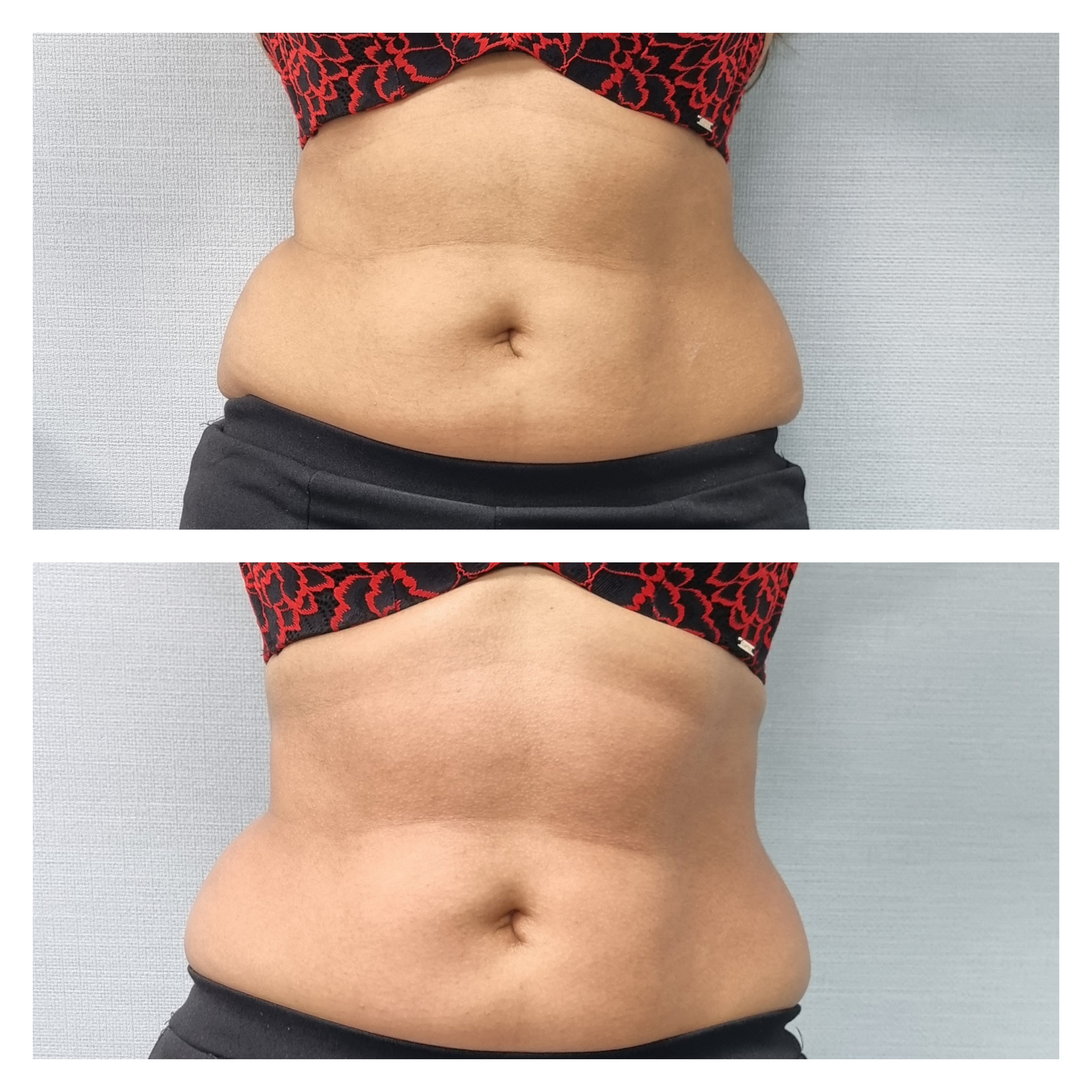T-Shape 2 result — T shape2 after 1 front permission to use